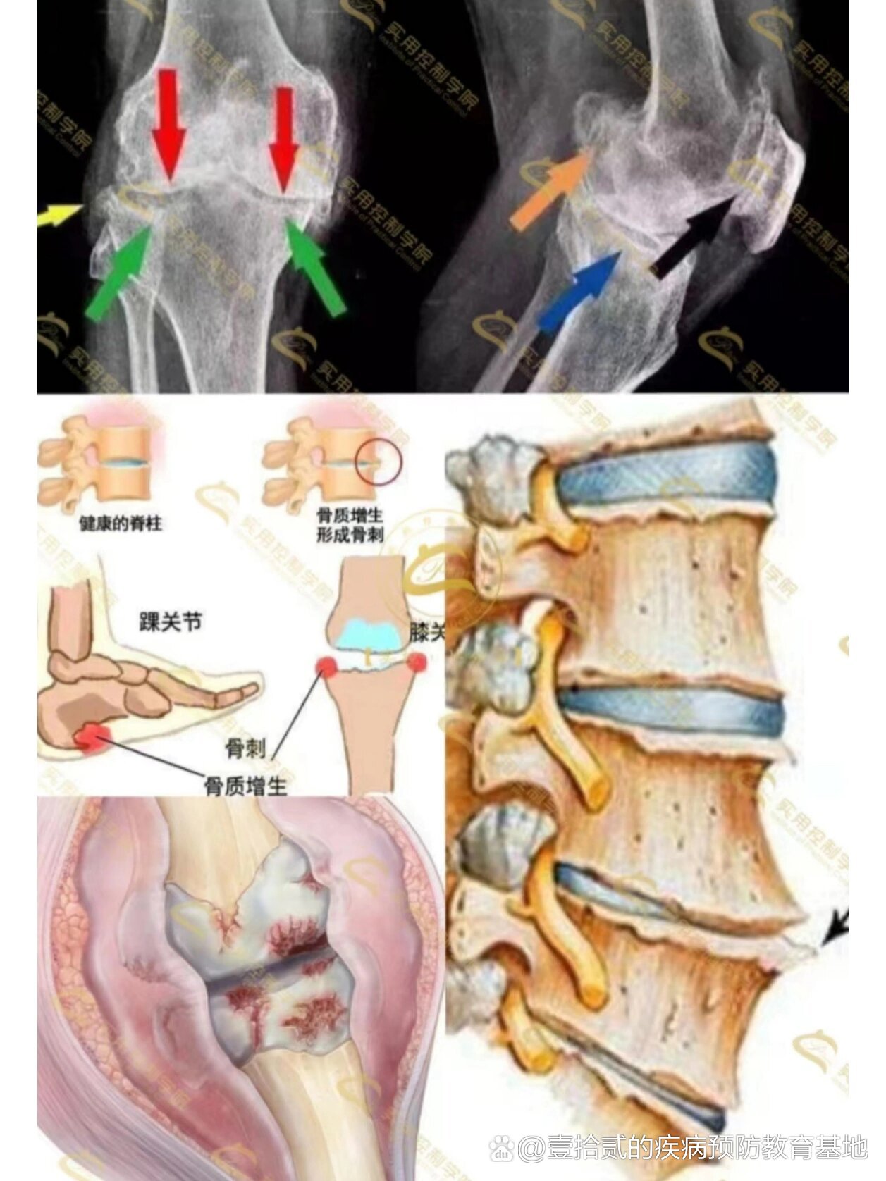 椎小关节骨质增生图片