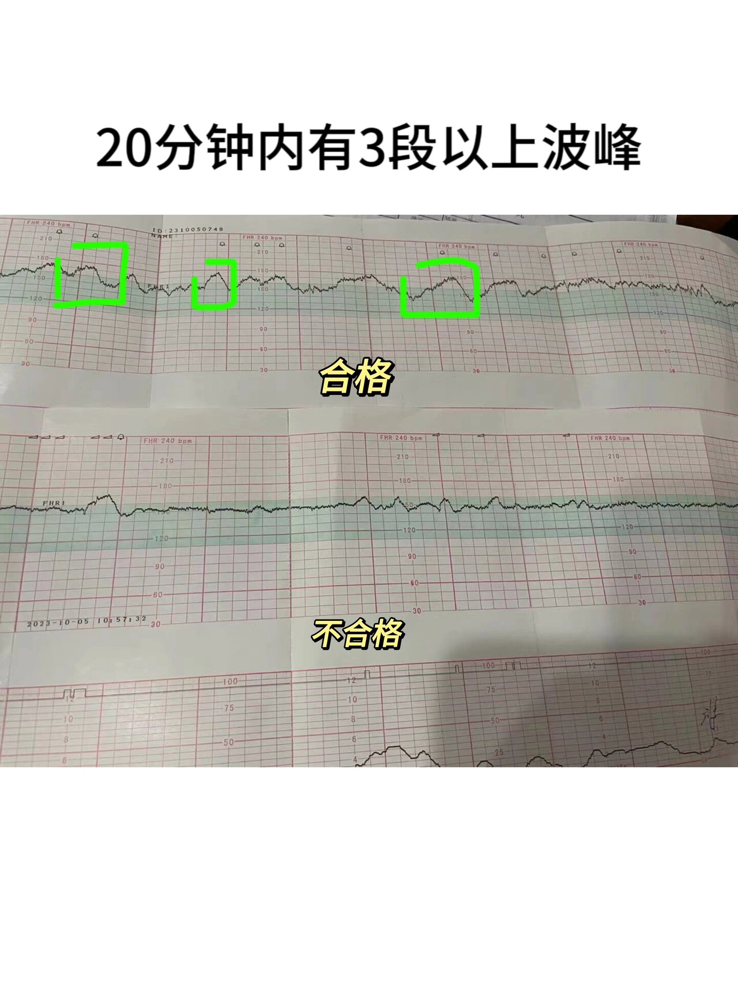 原来看懂胎心监护图这么简单7515胎监一次过7515