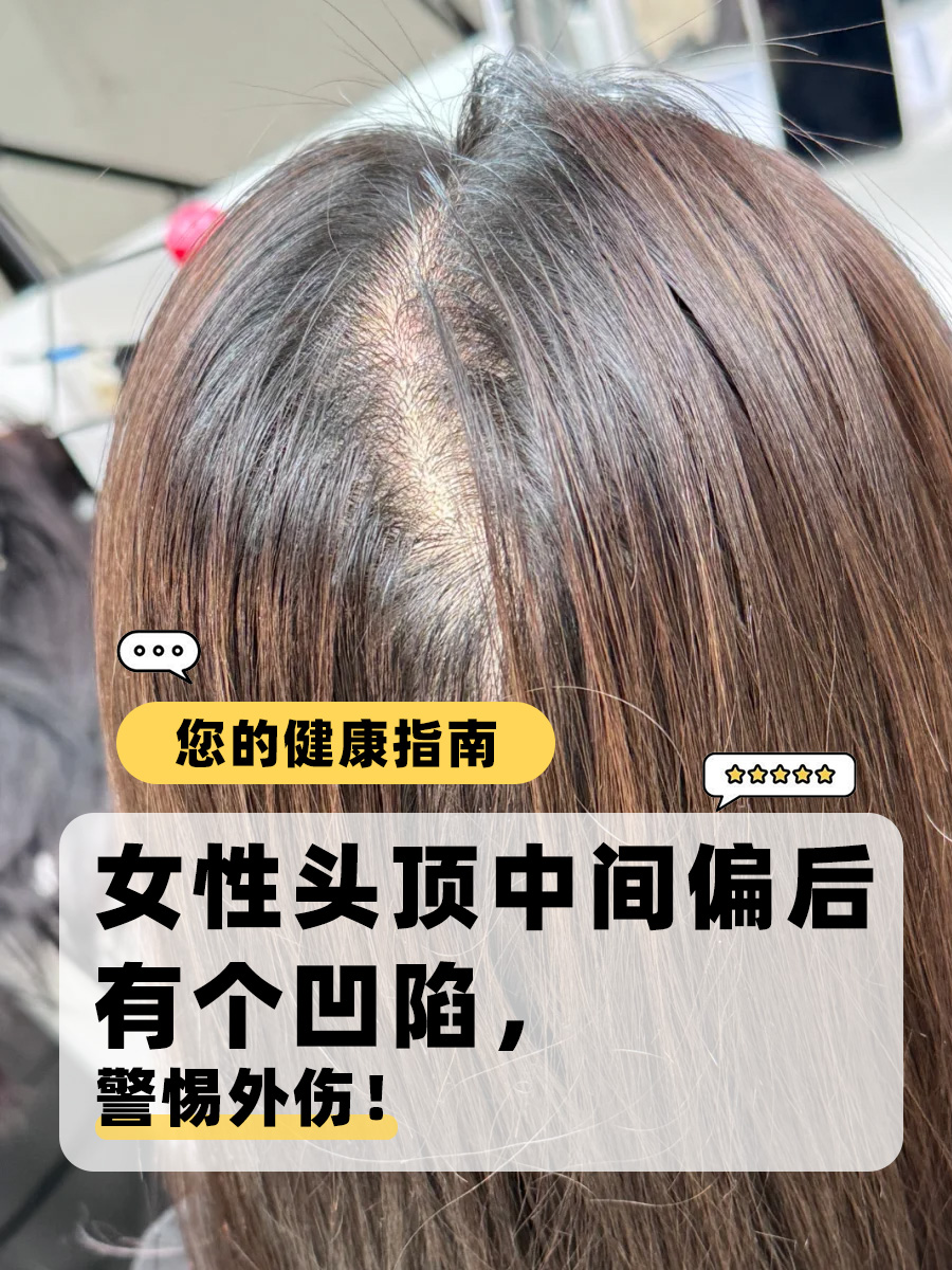 女性头顶中间偏后有个凹陷,警惕外伤!
