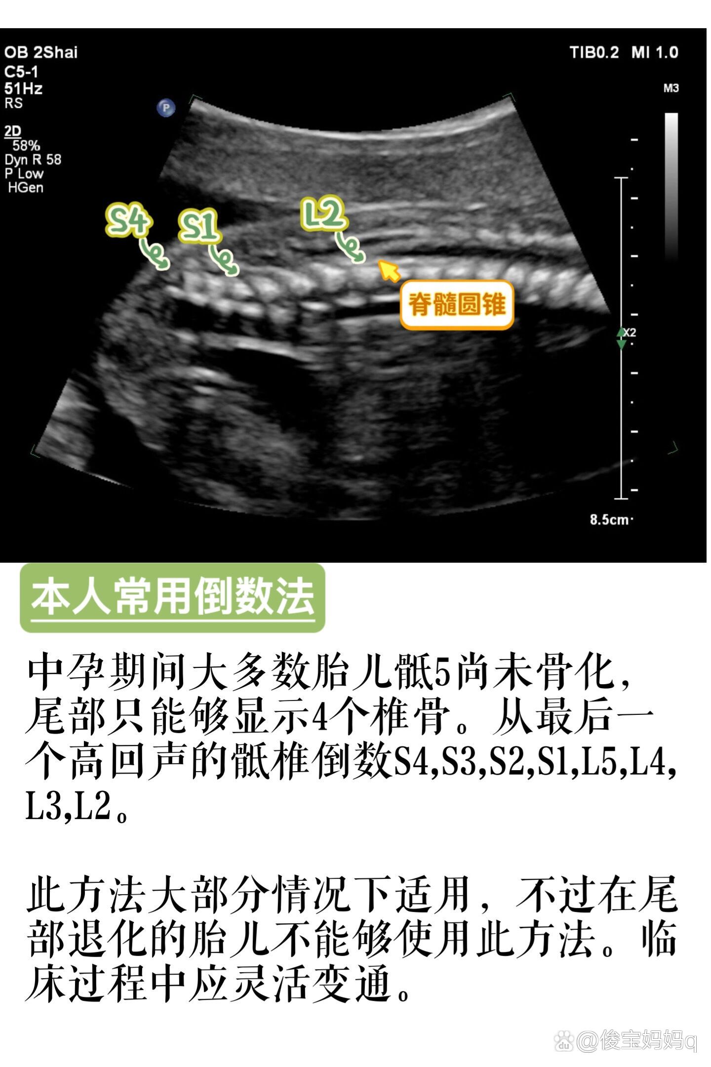 接上篇,脊髓圆锥超声定位方法