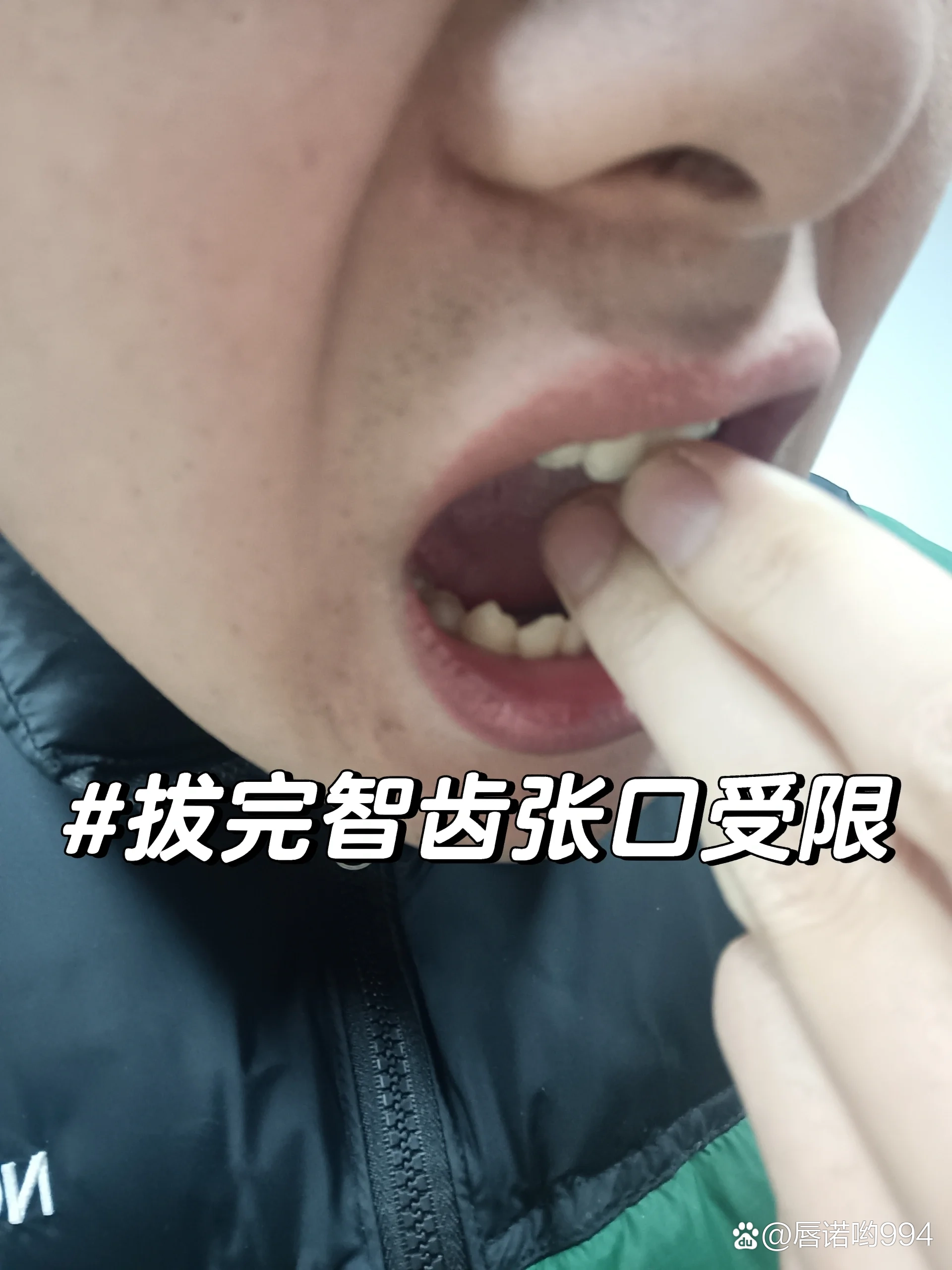 拔完智齿张口受限