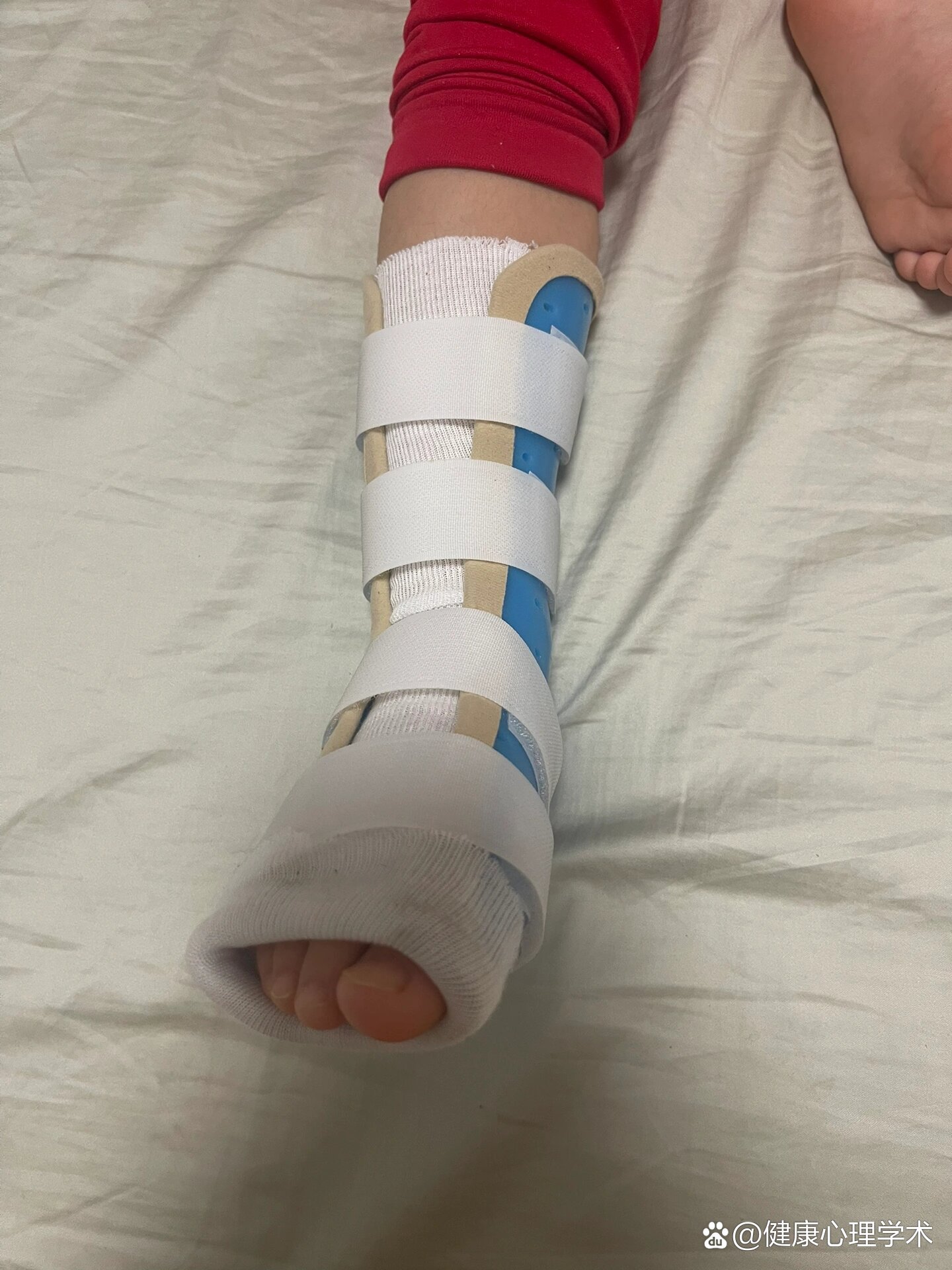 3岁儿童骨折儿研所就医经验分享