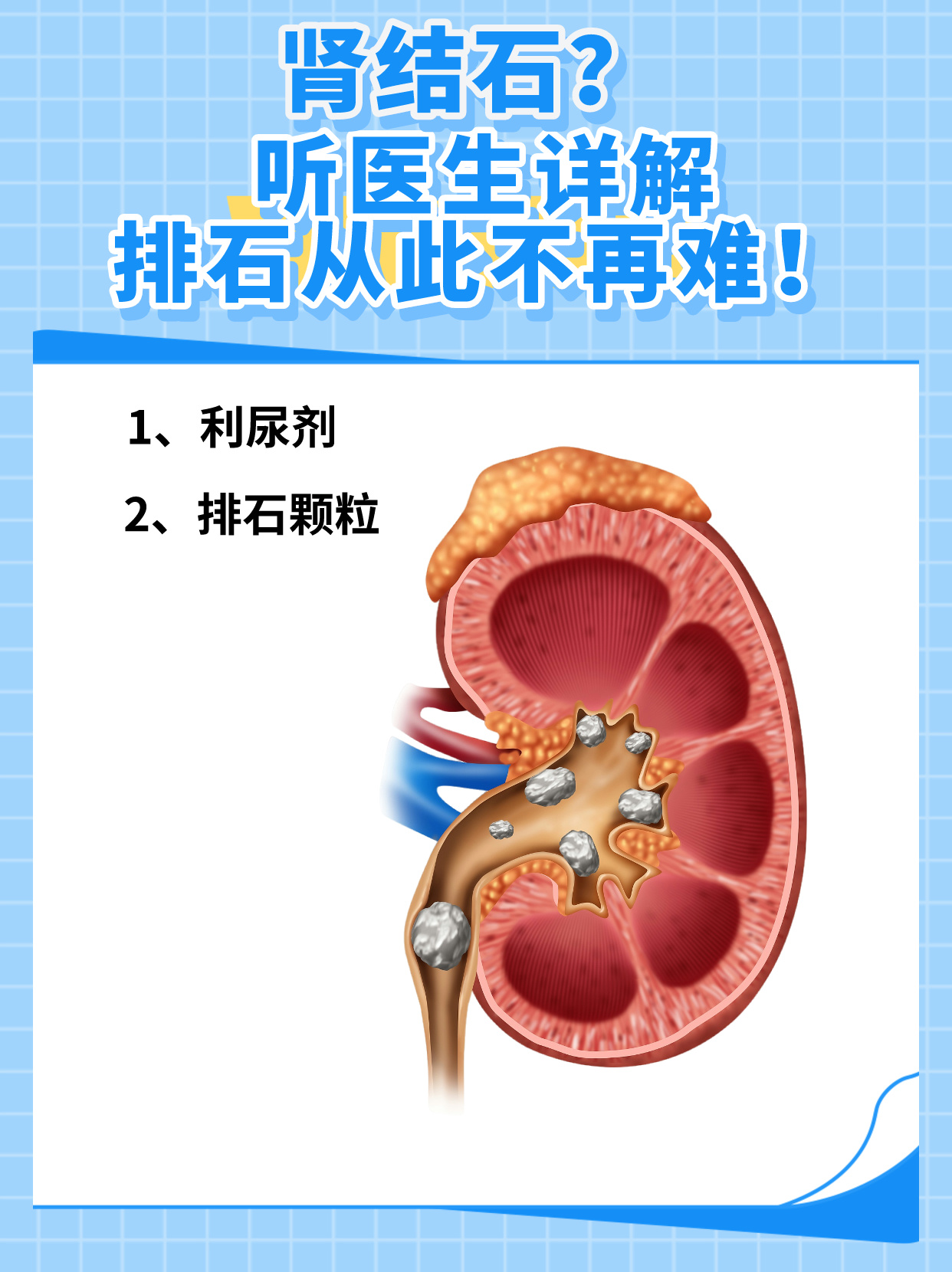 肾结石排石图解图片