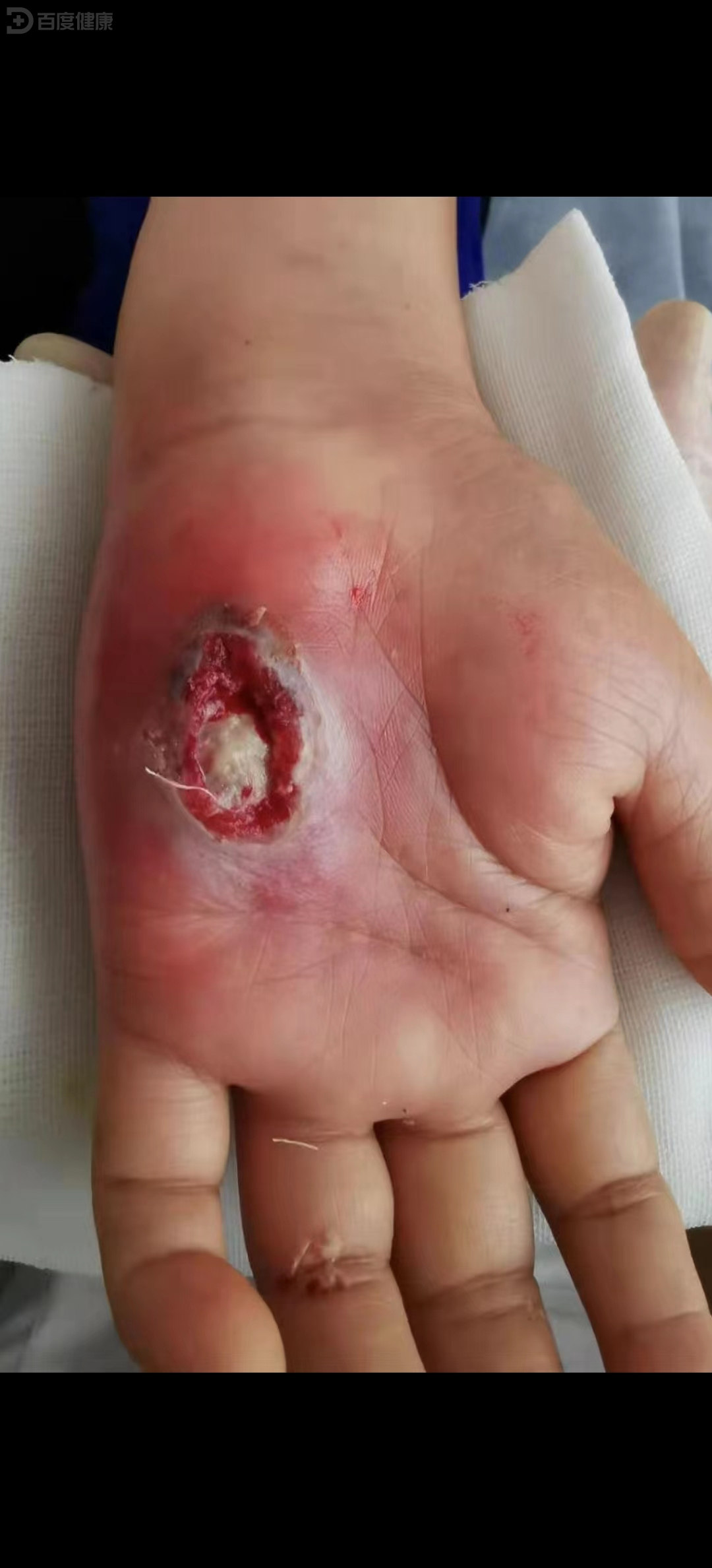 皮肤溃烂,抗生素无效要考虑坏疽性脓皮病