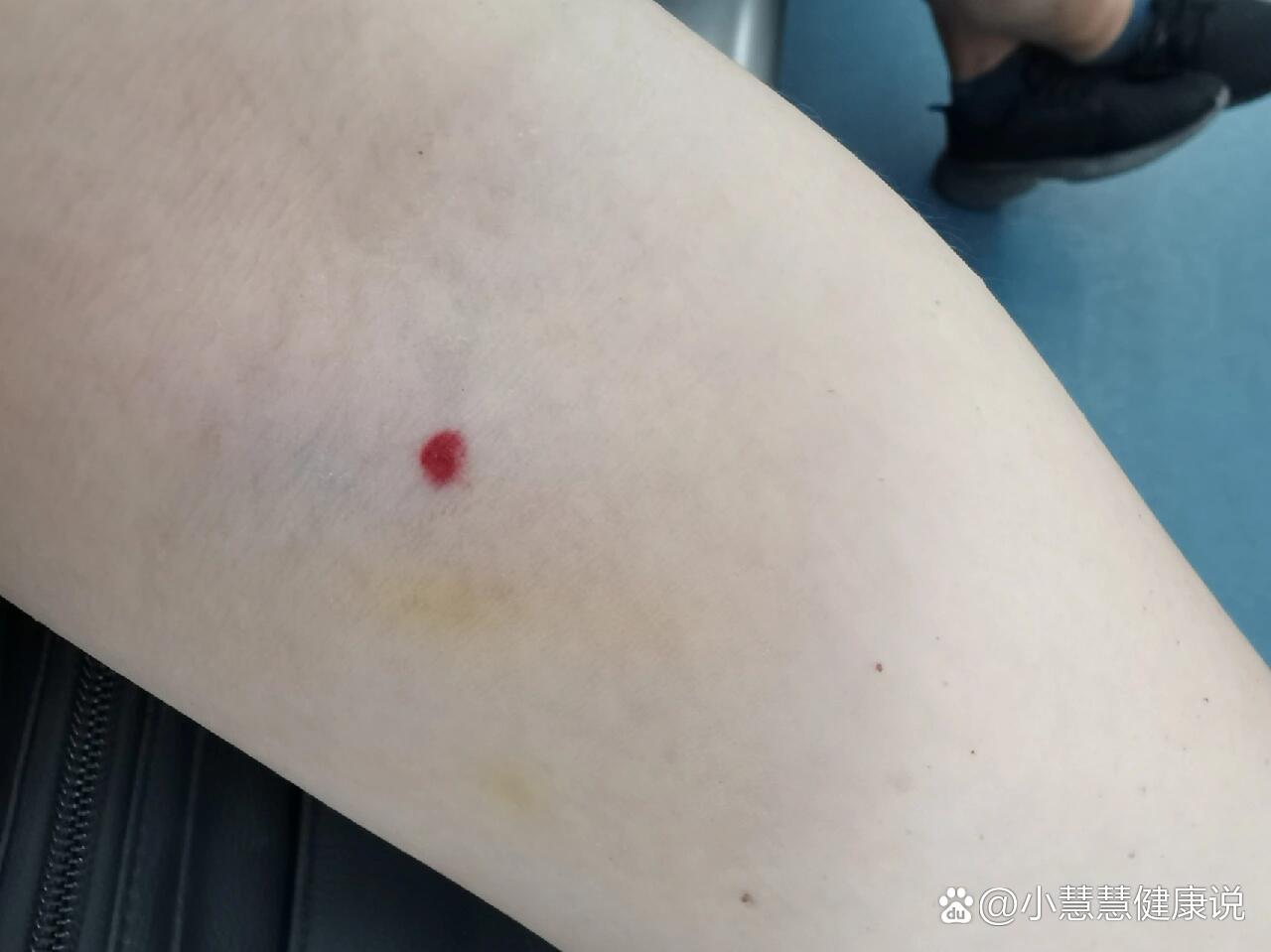 发现抽血针孔处出现了鲜红色血点,像是皮下出血