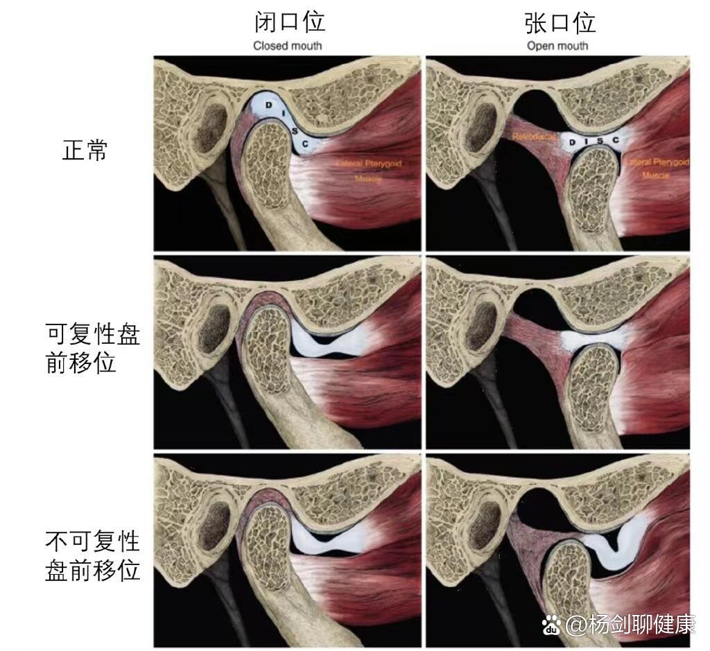 颞颌关节炎症状图片