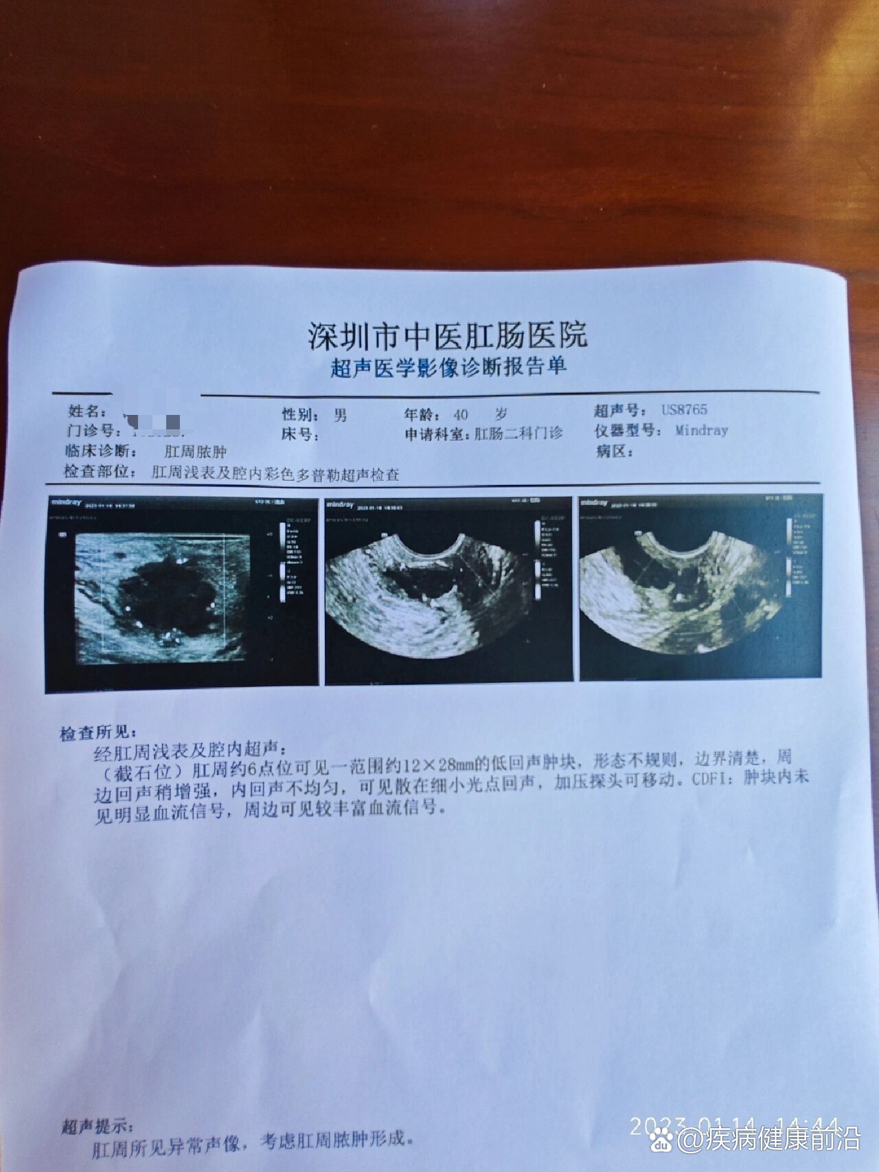 手术恢复全过程 br 2023年1月11日下午 br 突然间感觉肛门里面疼痛