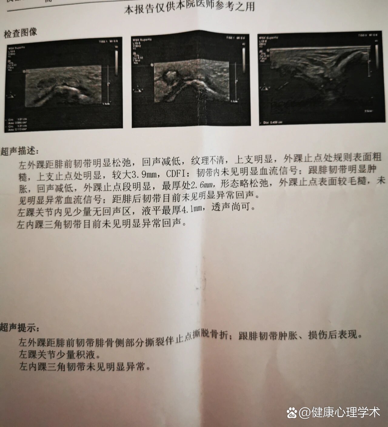 今儿个终于有点搞明白韧带损伤的级别了