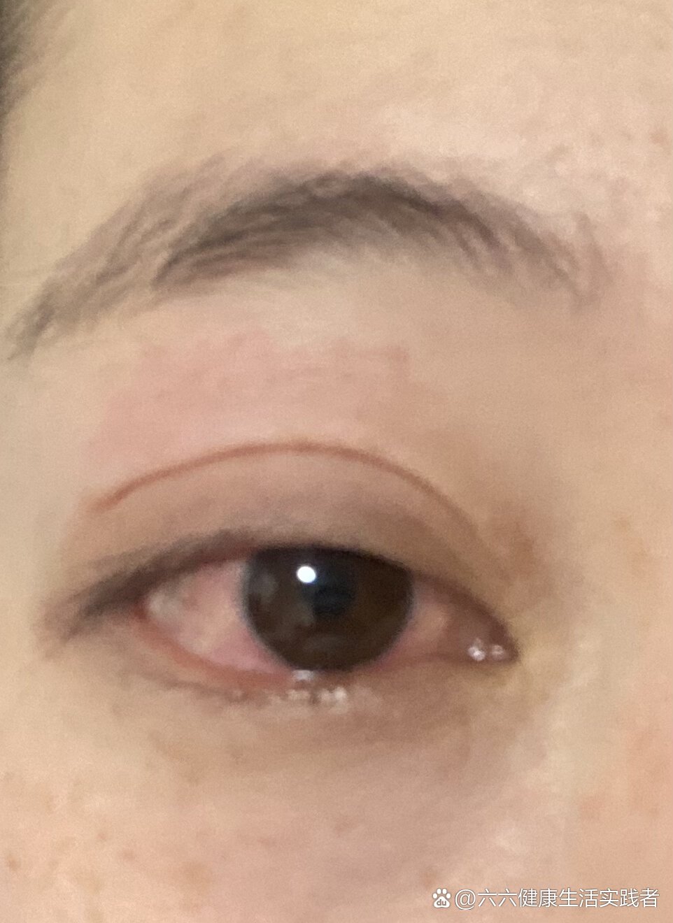 眼睛怎么会过敏啊