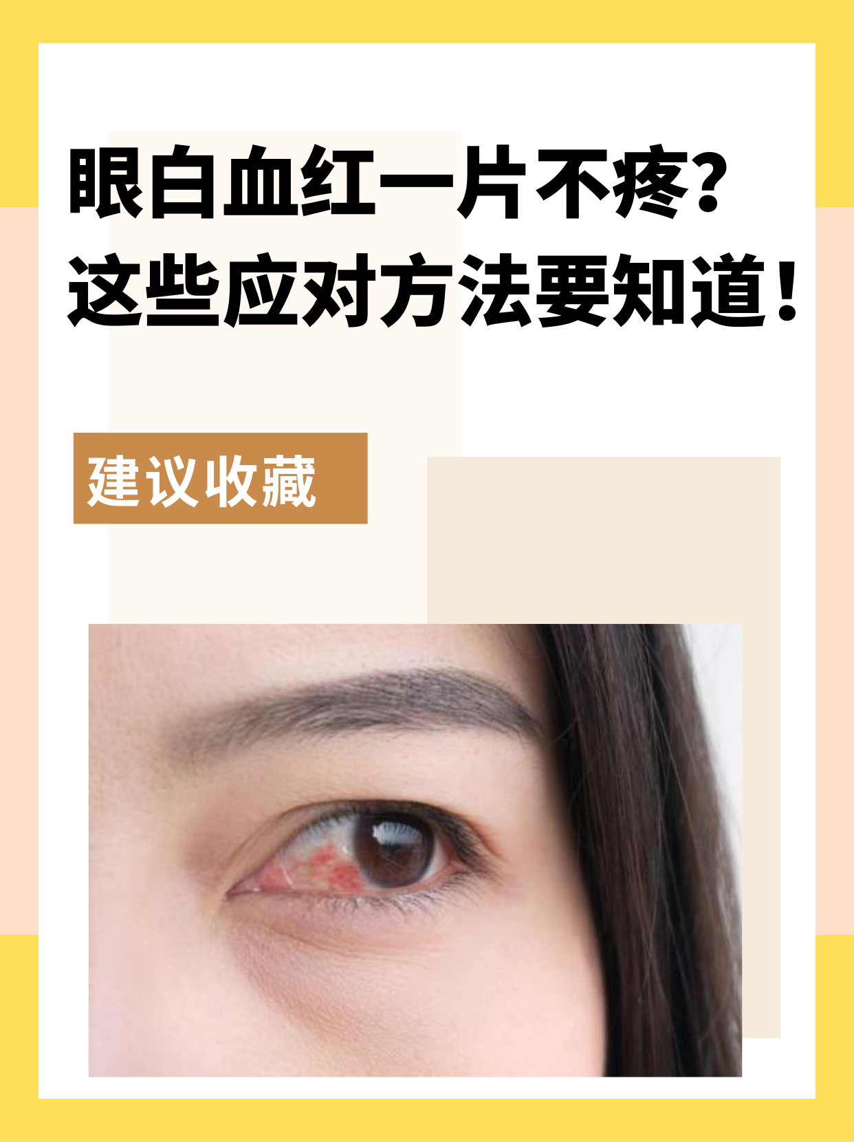 这位患者自述在家照镜子发现眼白👀血红一片,但是自己感觉不到疼痛