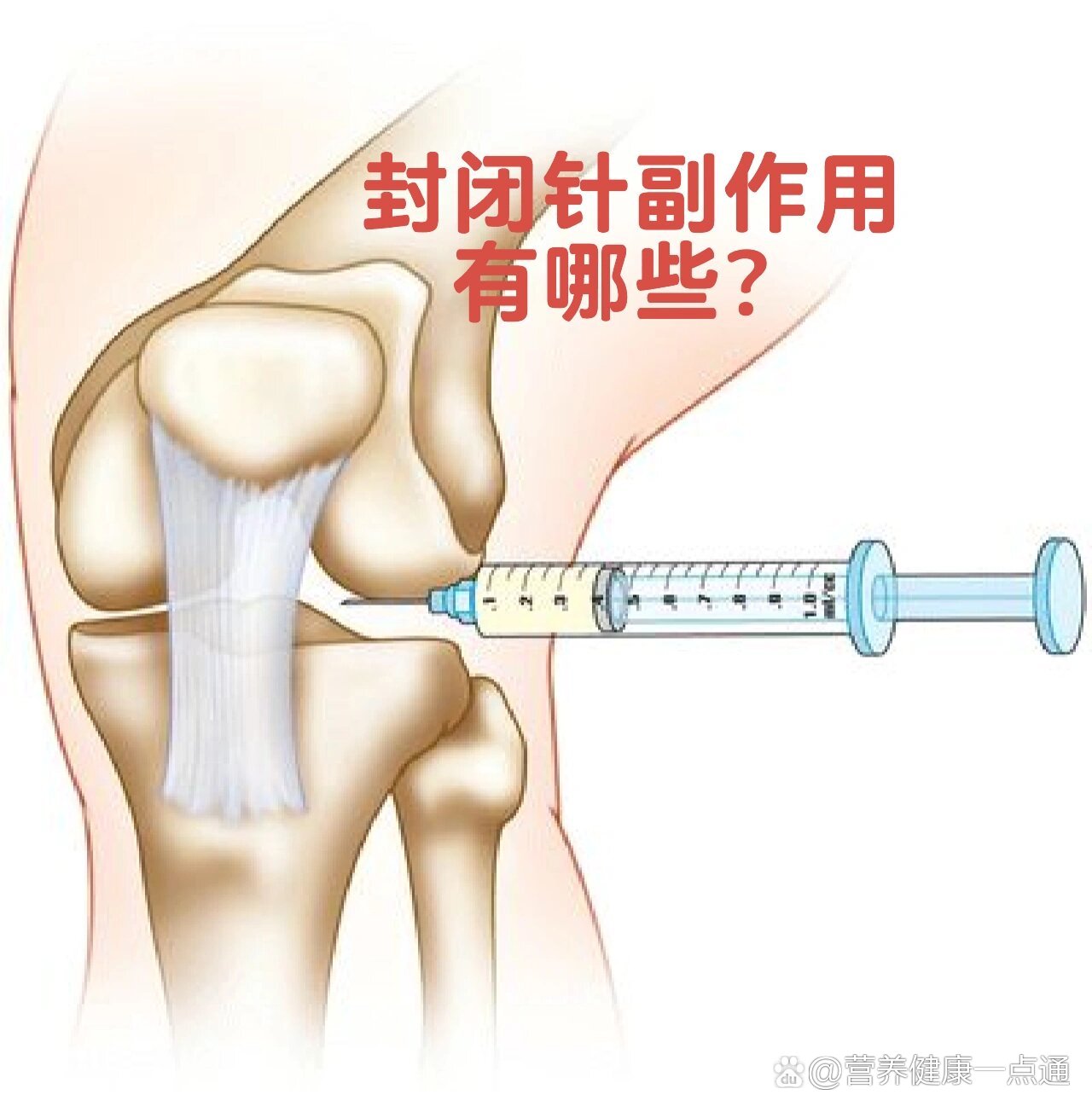 膝关节封闭注射示意图图片