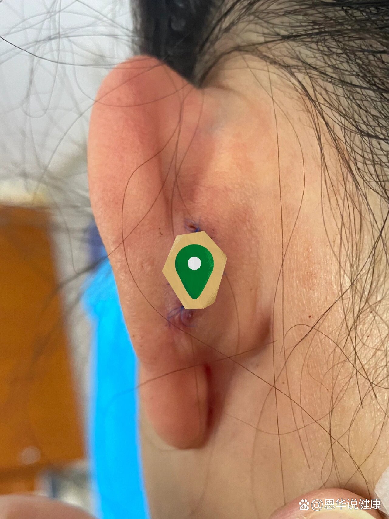 3次切除耳洞瘢痕疙瘩增生分享