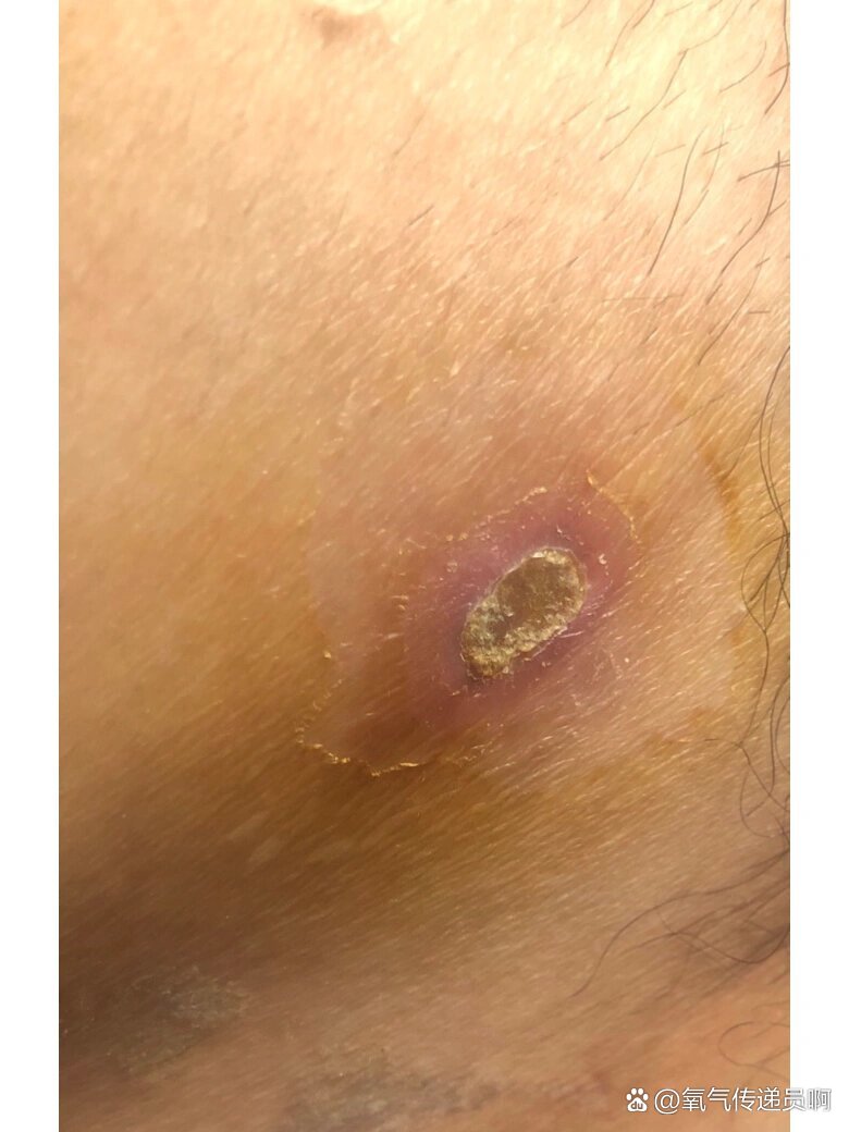 引流管伤口痊愈需要多久?