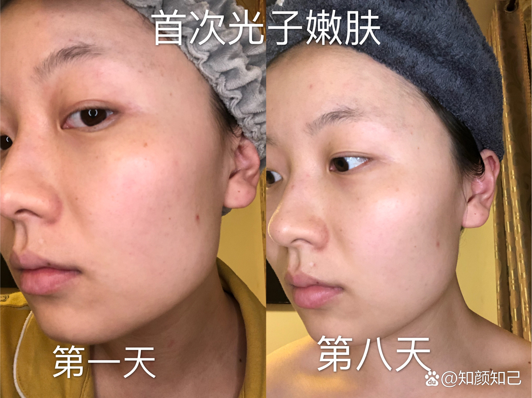 光子嫩肤&新氧美次卡到底怎么样❗❗❗