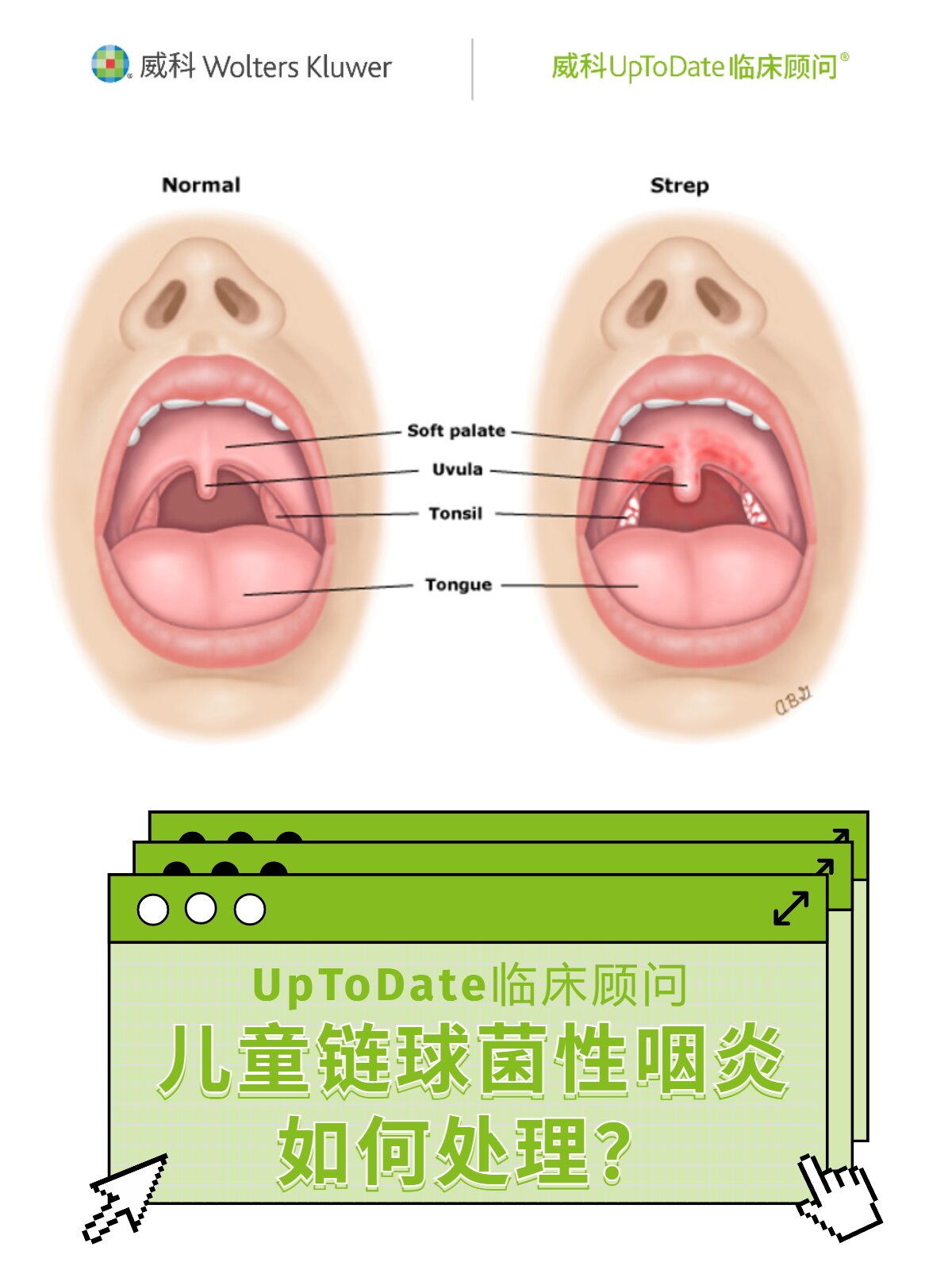 循证育儿|孩子链球菌性咽炎如何科学处理?
