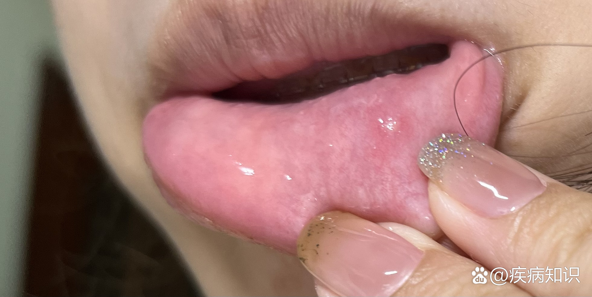 黏液腺囊肿(治愈过程)
