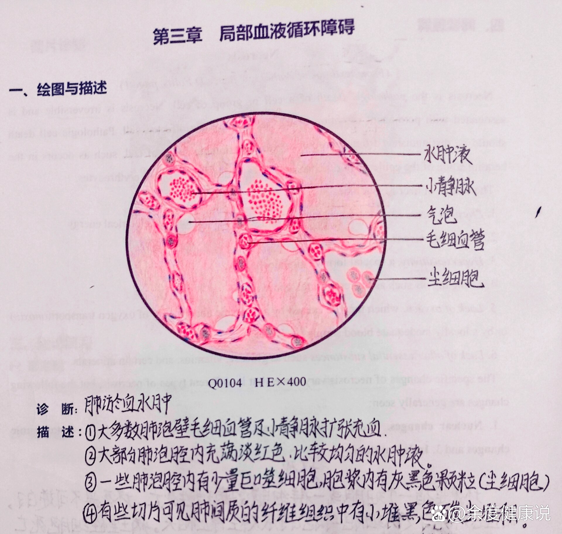 急性肺淤血红蓝手绘图图片