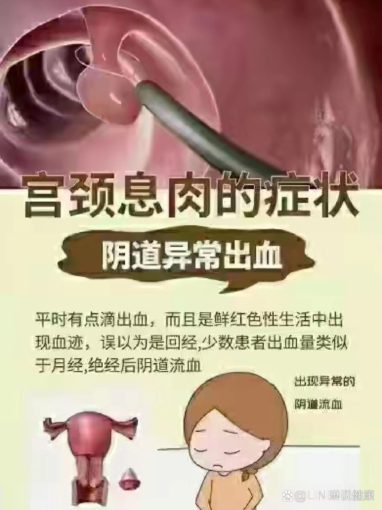 宫颈蜕膜息肉图片图片