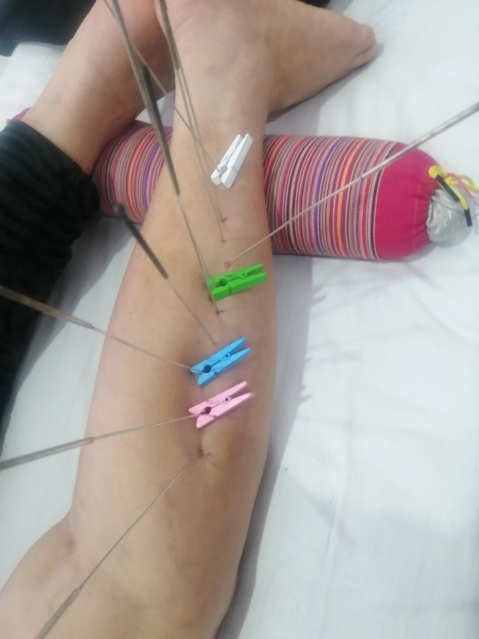 宣蛰人银质针治疗小腿胀痛1例