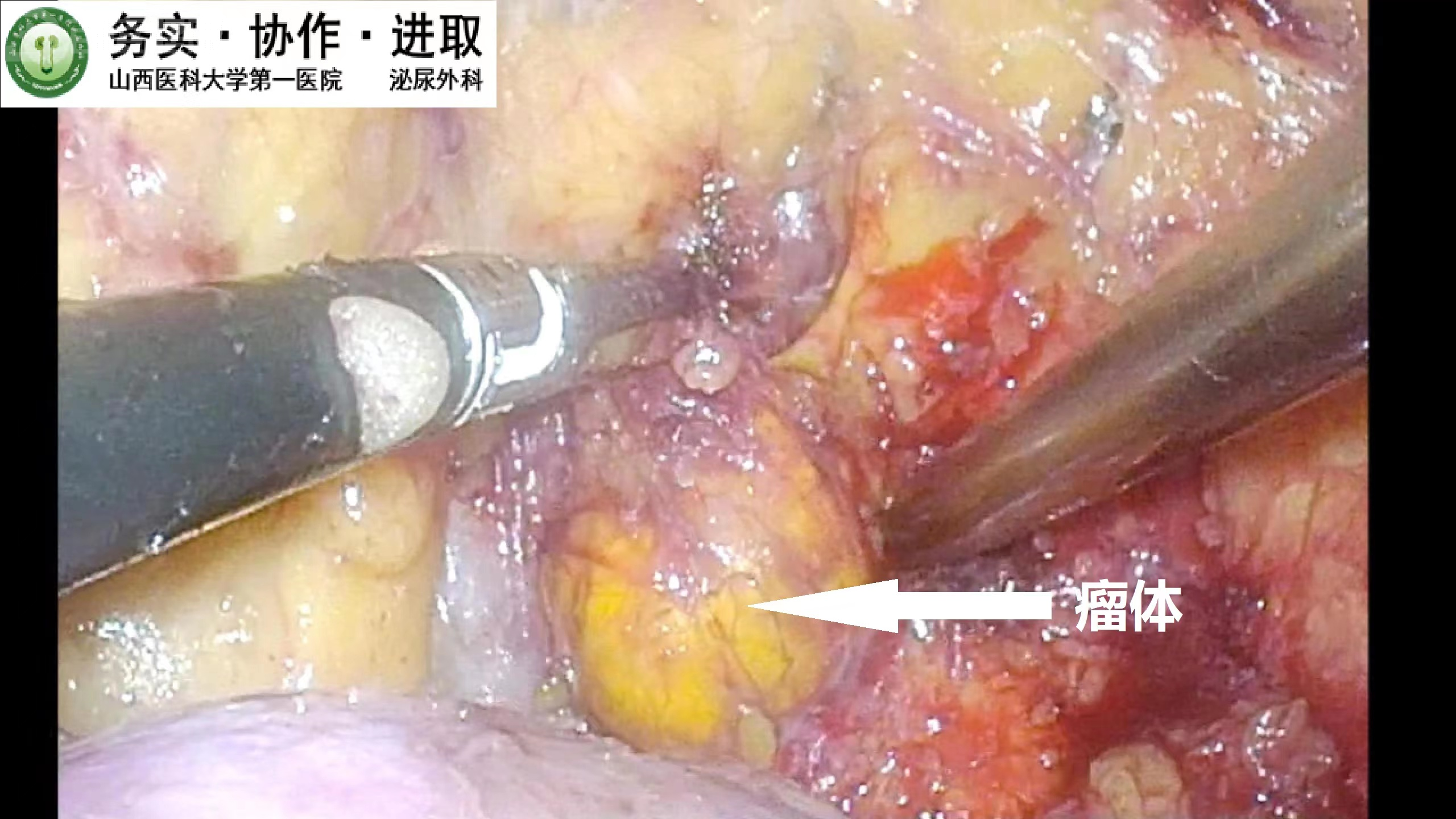 切瘤保功,快速康复:一例典型的肾上腺肿瘤后腹腔镜微创切除手术