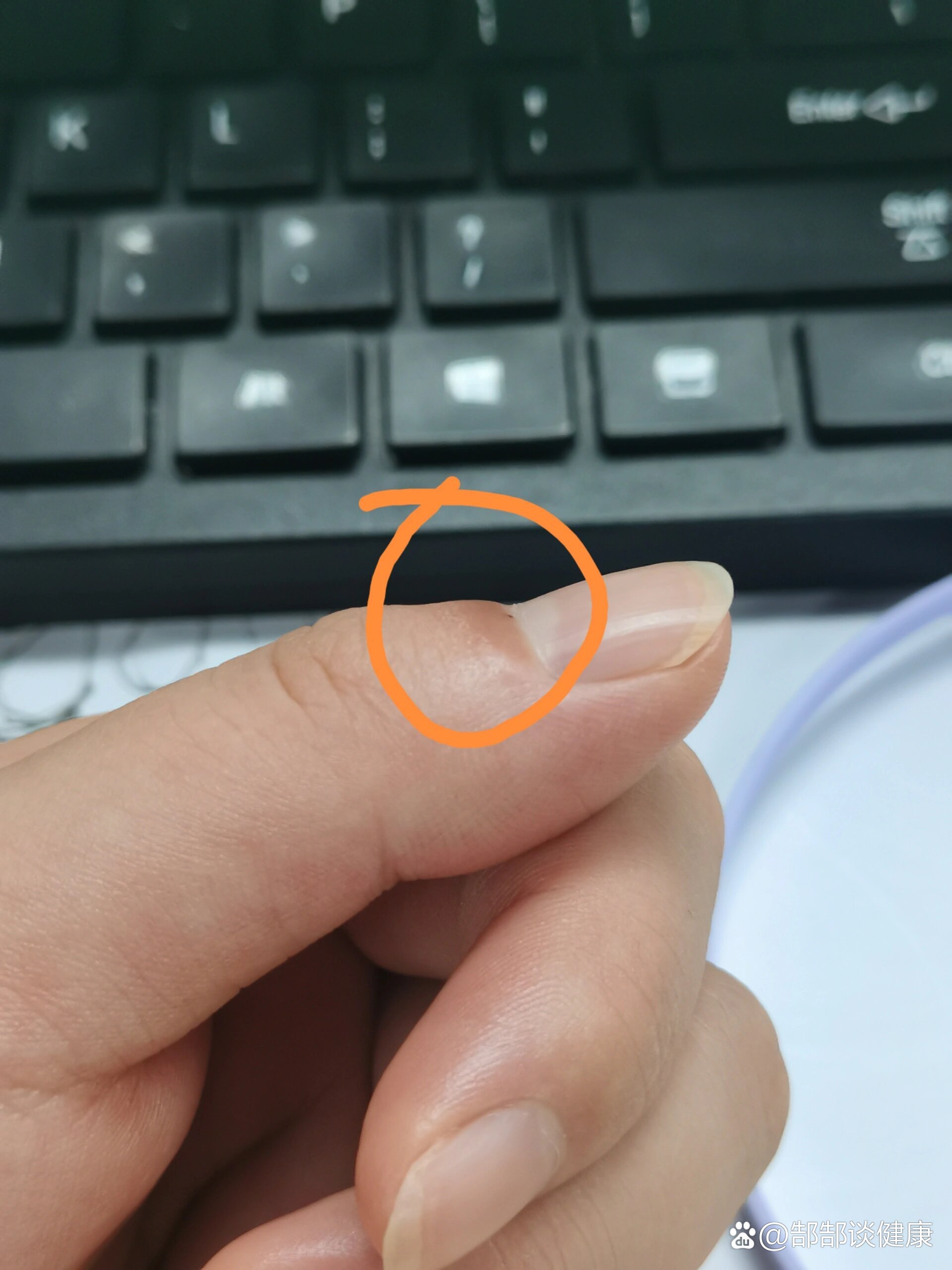 大拇指这个位置,肿了,有点痒,怎么回事