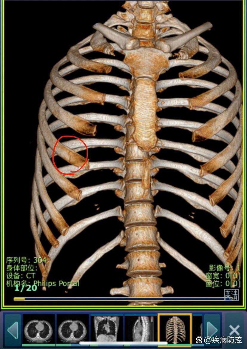 肋骨骨裂图片轻微图片