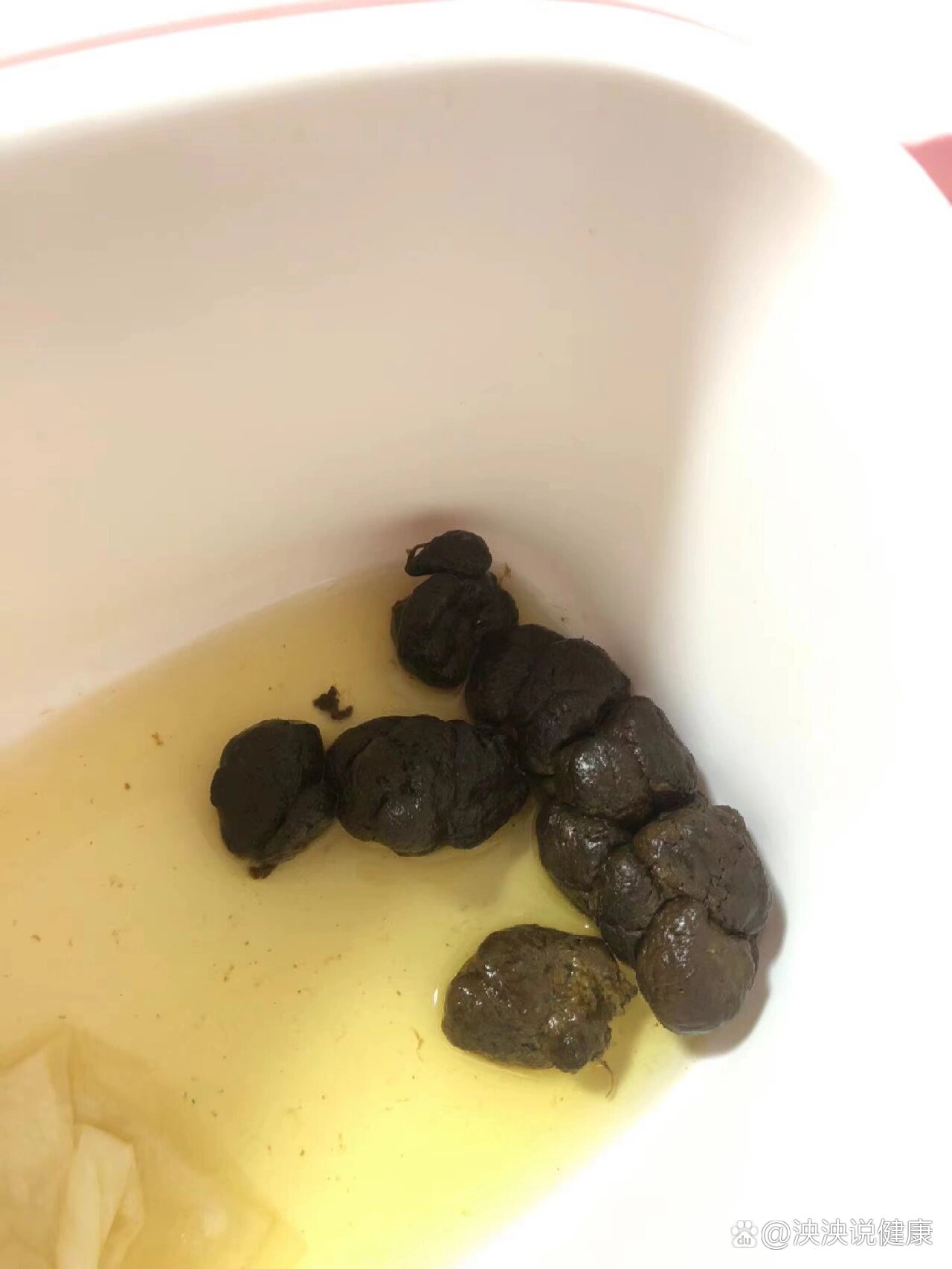 宝宝便便分析,便秘积食消化不良便便图片