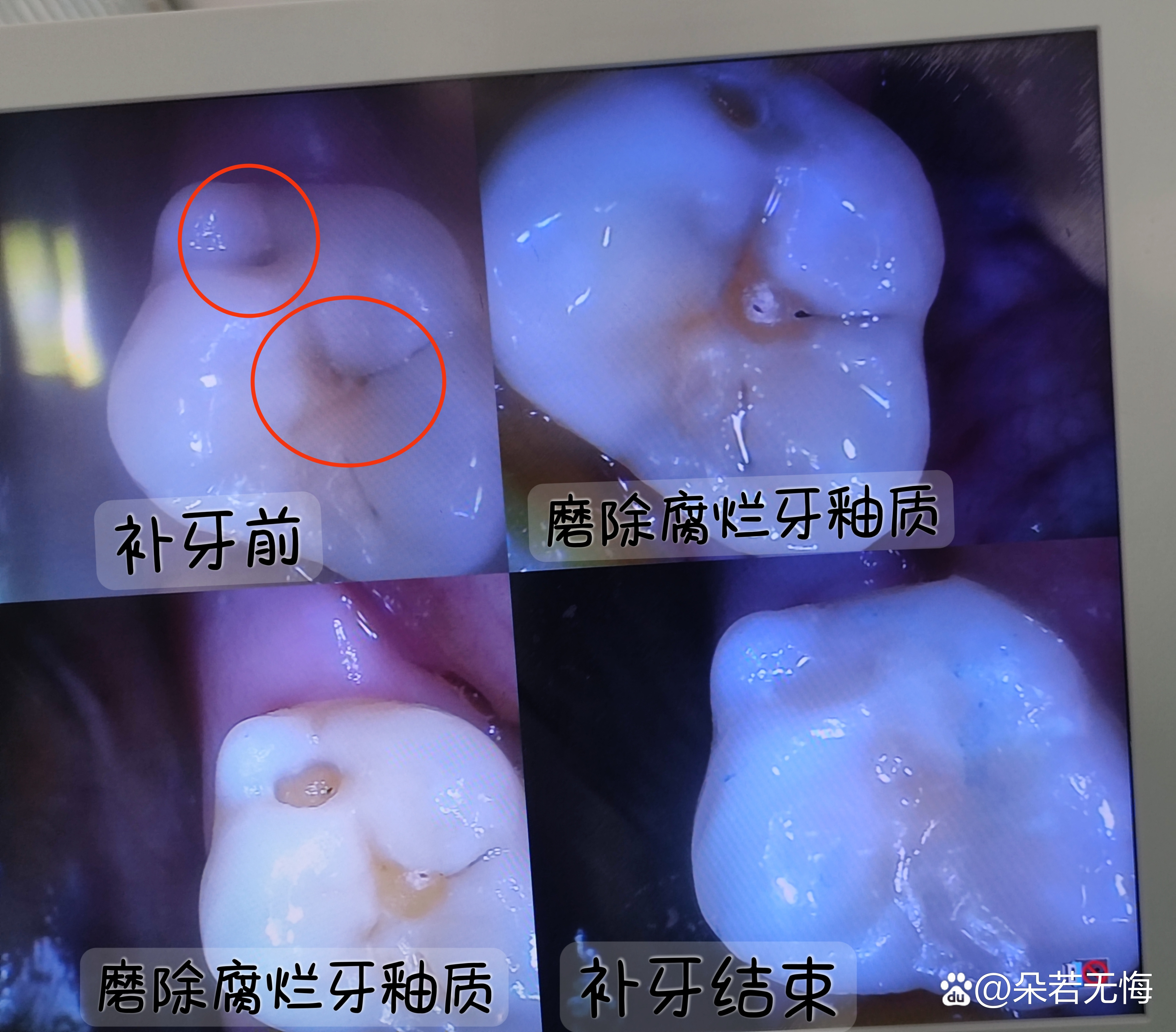 千万不要去补牙洞