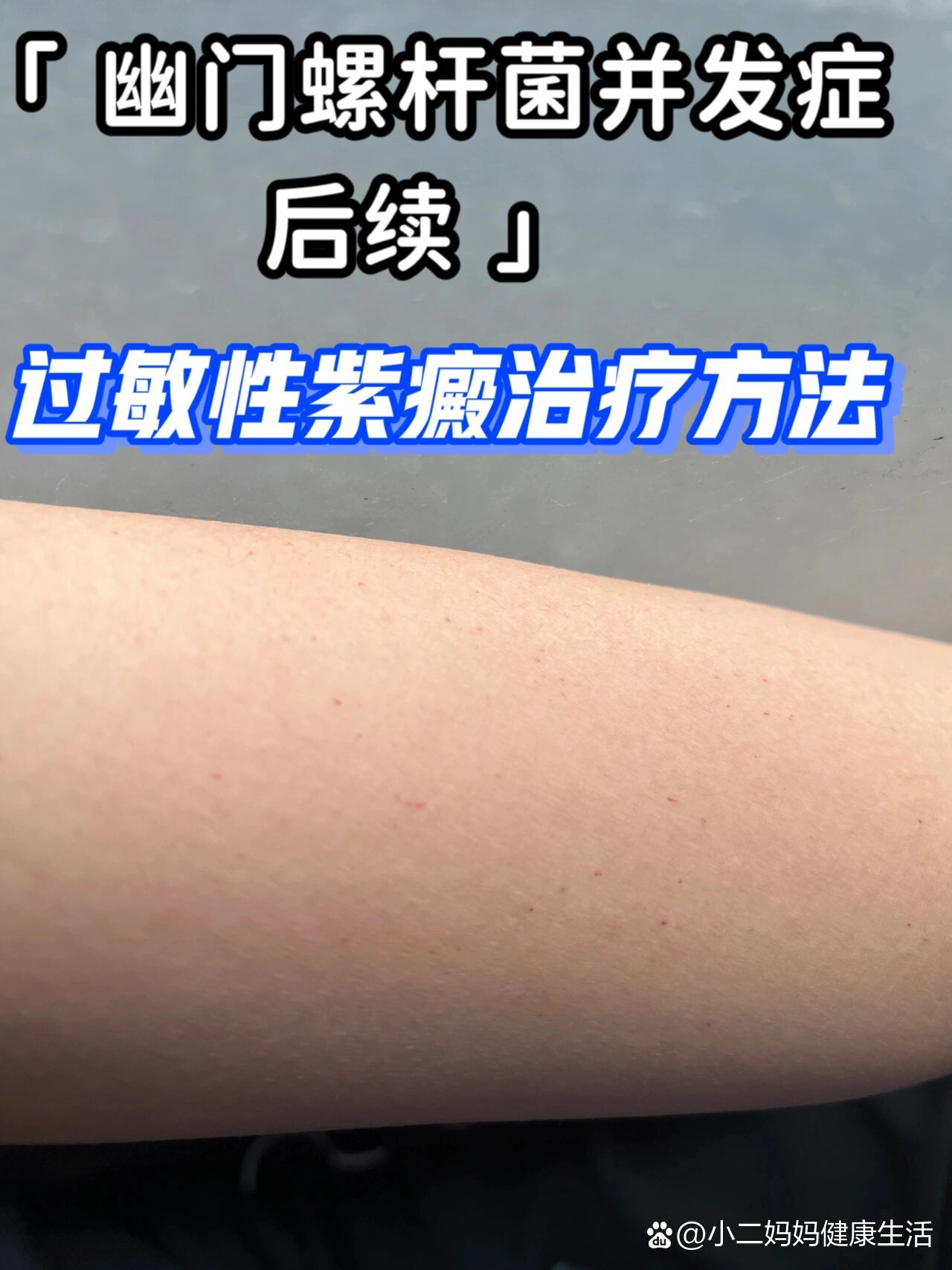 过敏性紫癜治疗方法