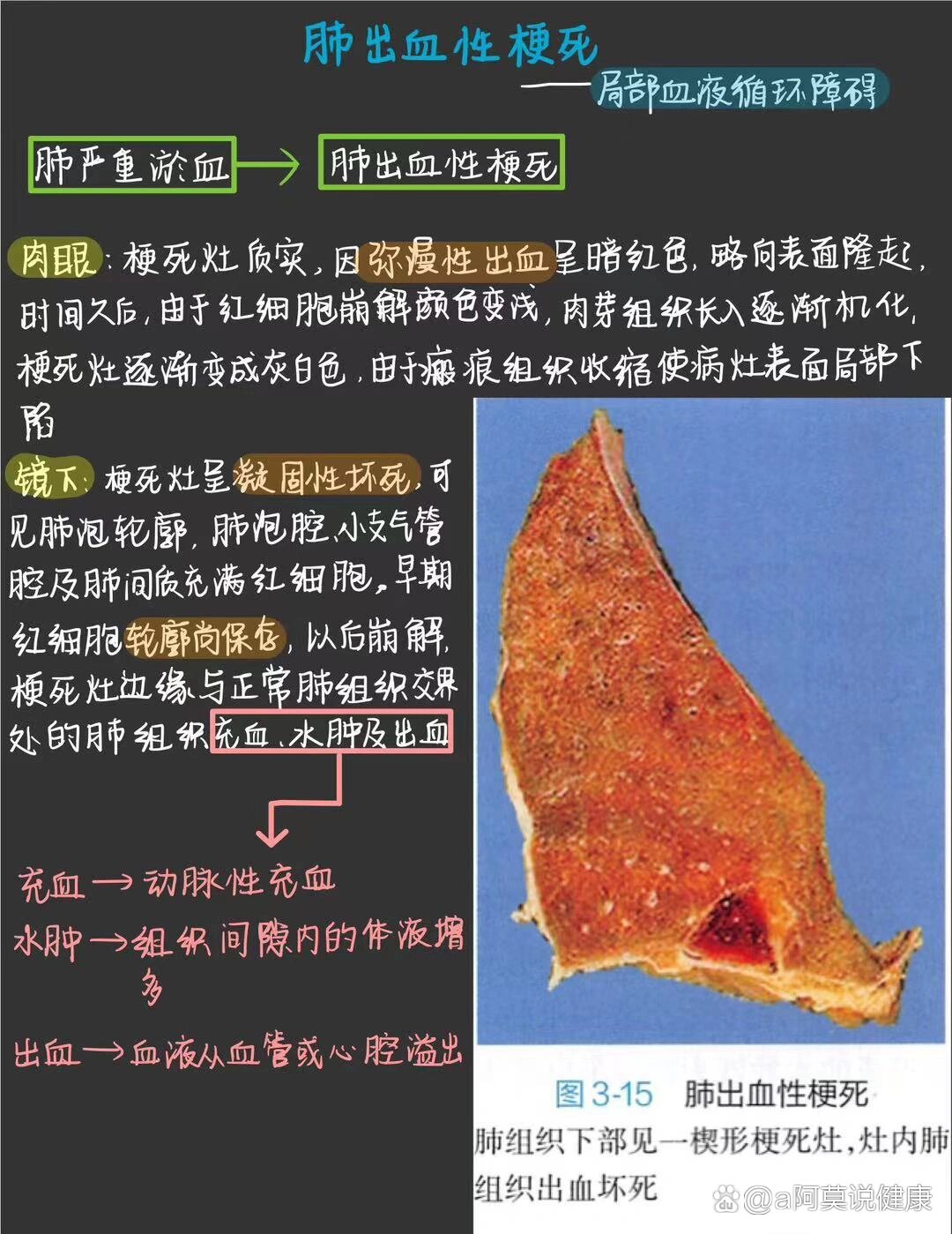 病理学‖肺出血性梗死