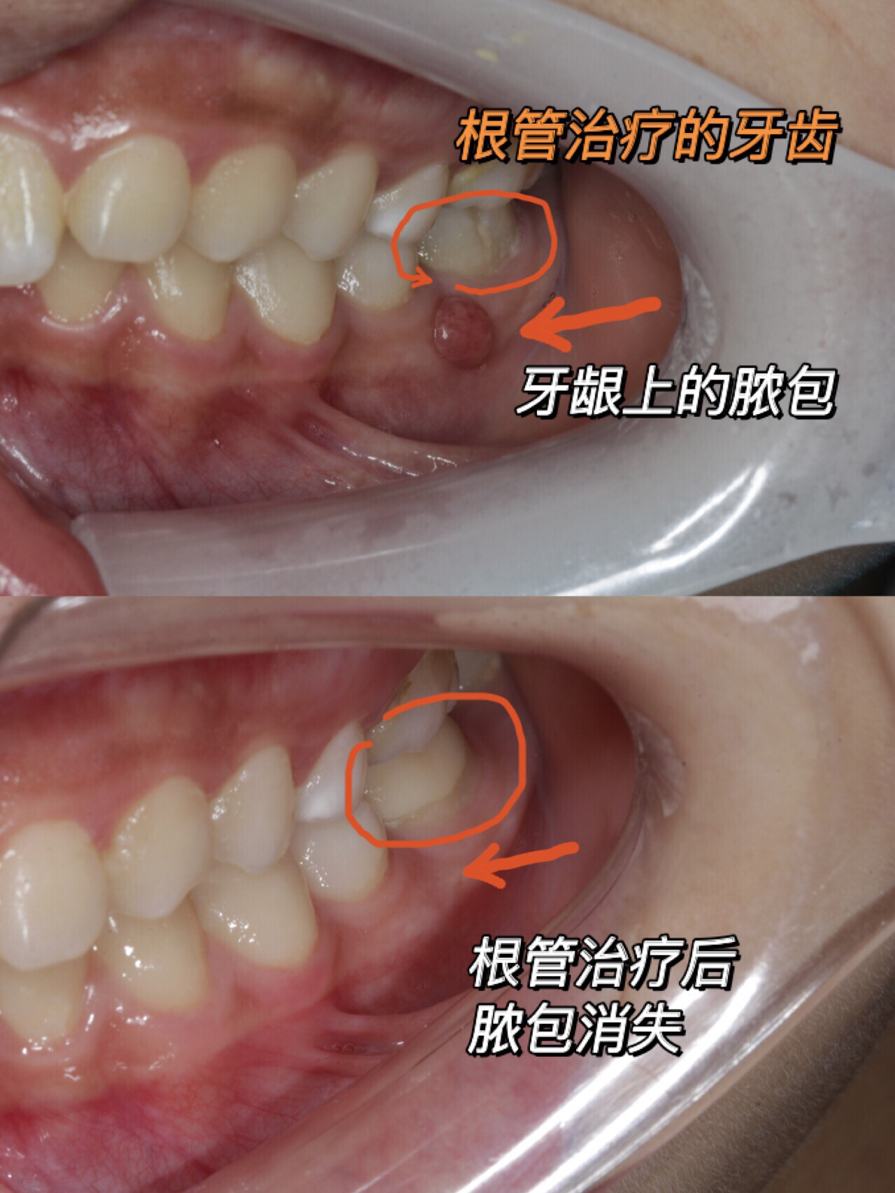 本来以为是牙龈发炎,吃点消炎药应该就没事了,没想到后来牙齿疼痛难忍