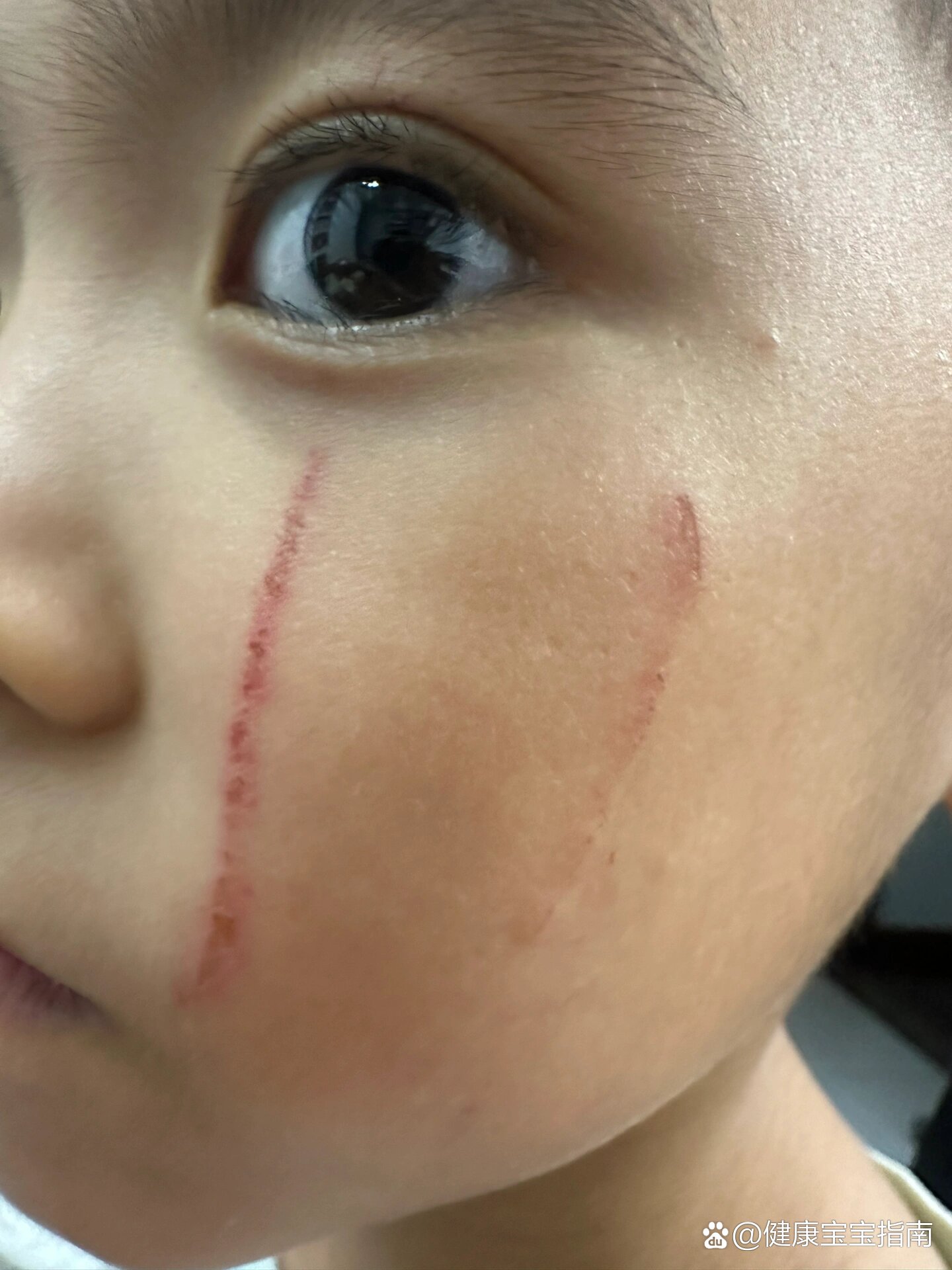 儿童脸部抓伤处理