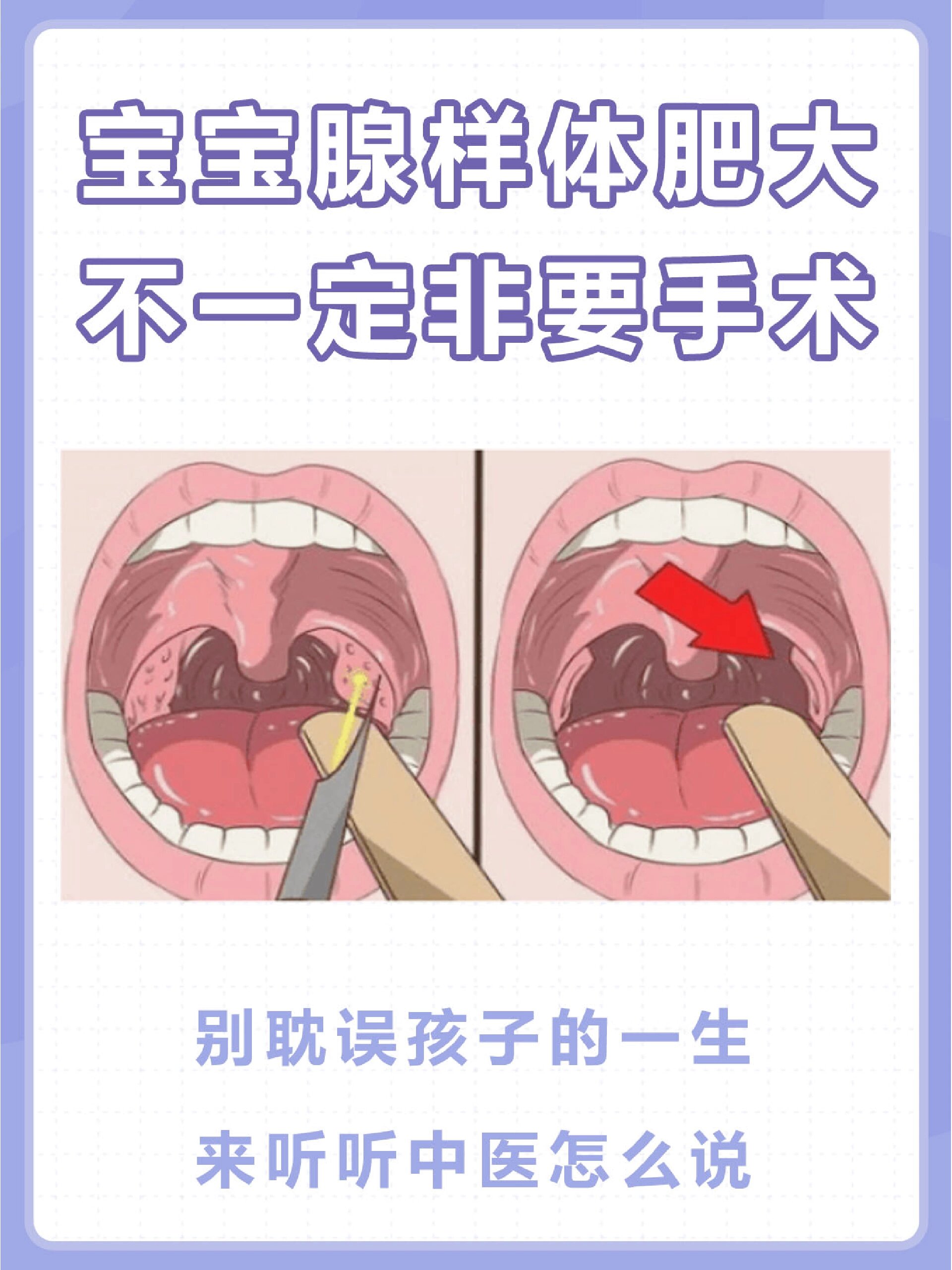 �宝宝腺样体肥大,不一定非要手术‼️