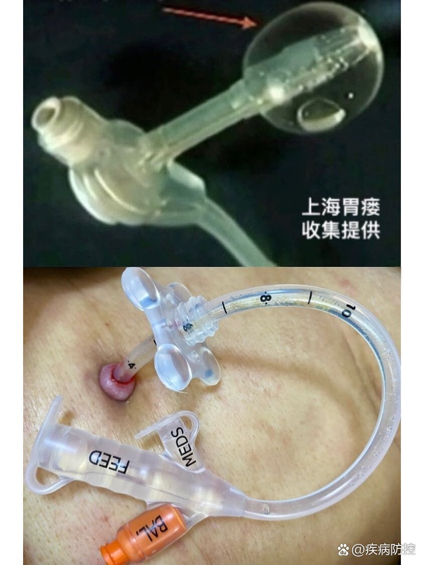 哈利雅德胃造瘘(胃造口)管简介