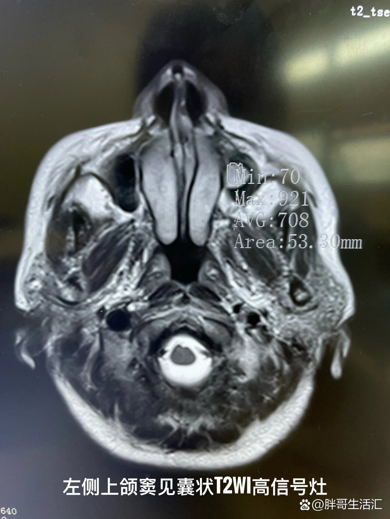 上颌窦黏膜囊肿mri