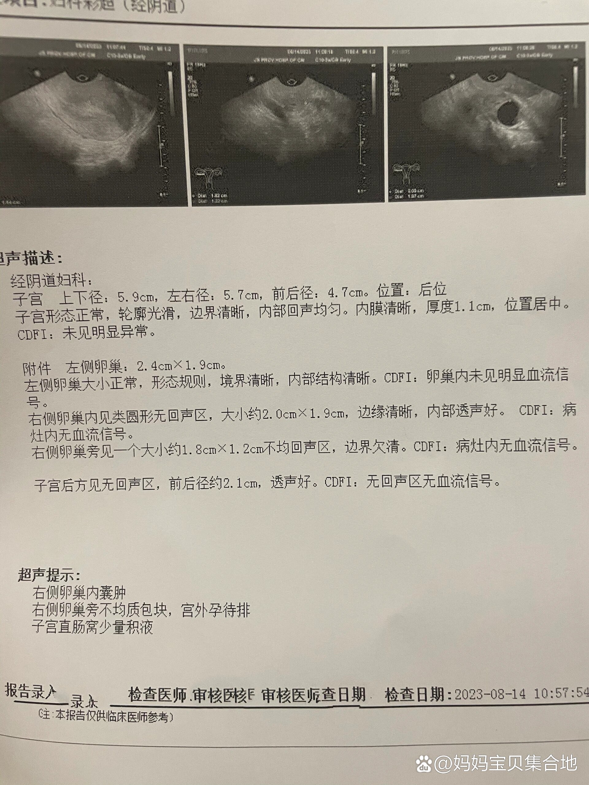  p>宫外孕中药保守治疗成功 br>  8月9日hcg667,查到右侧有一个1.5*1.