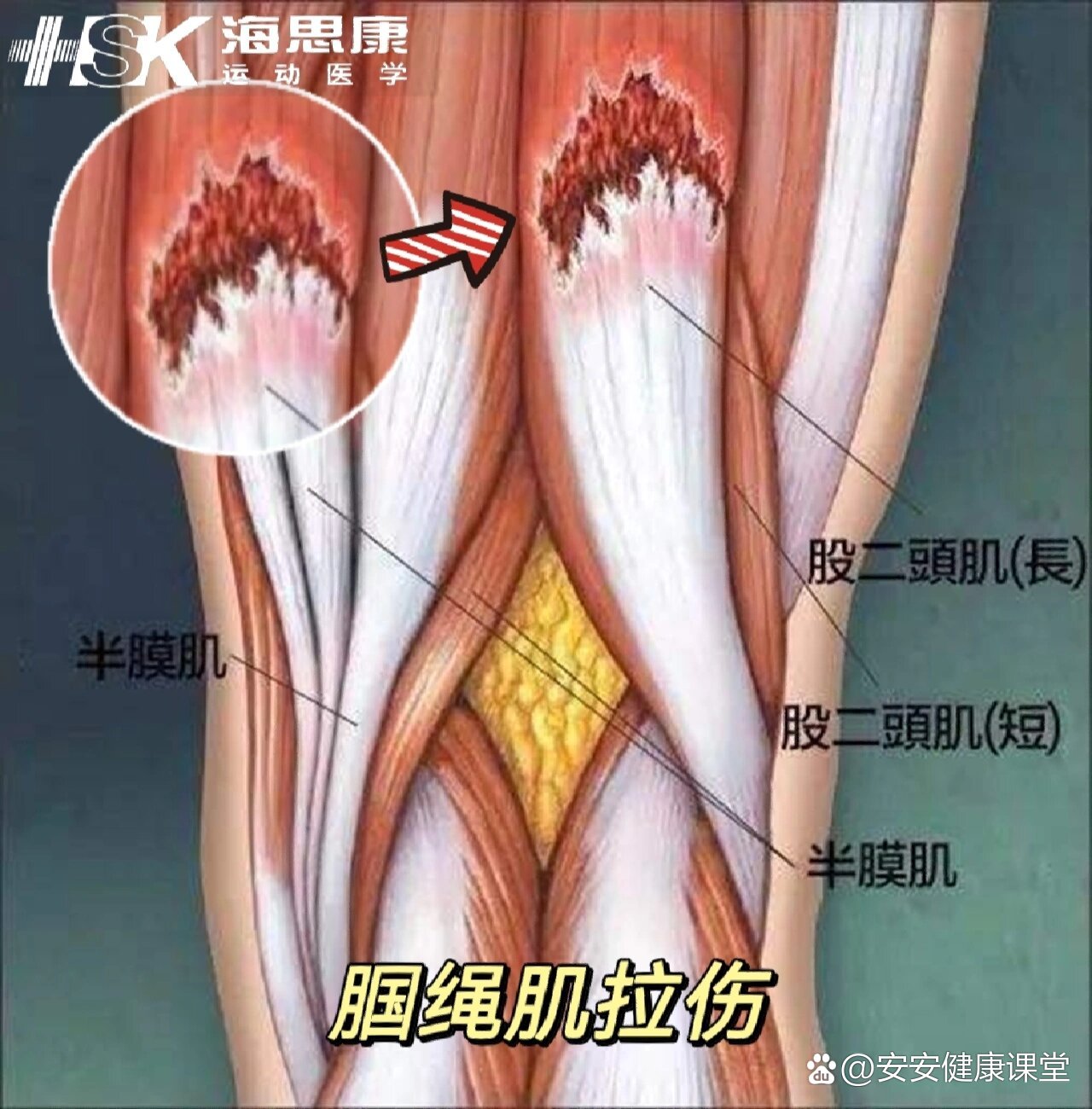 腘绳肌的位置图片