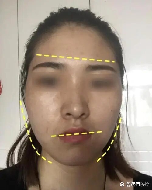 br>发现颜面部不对称畸形在面上部,面中部,面下部发生的概率分别为