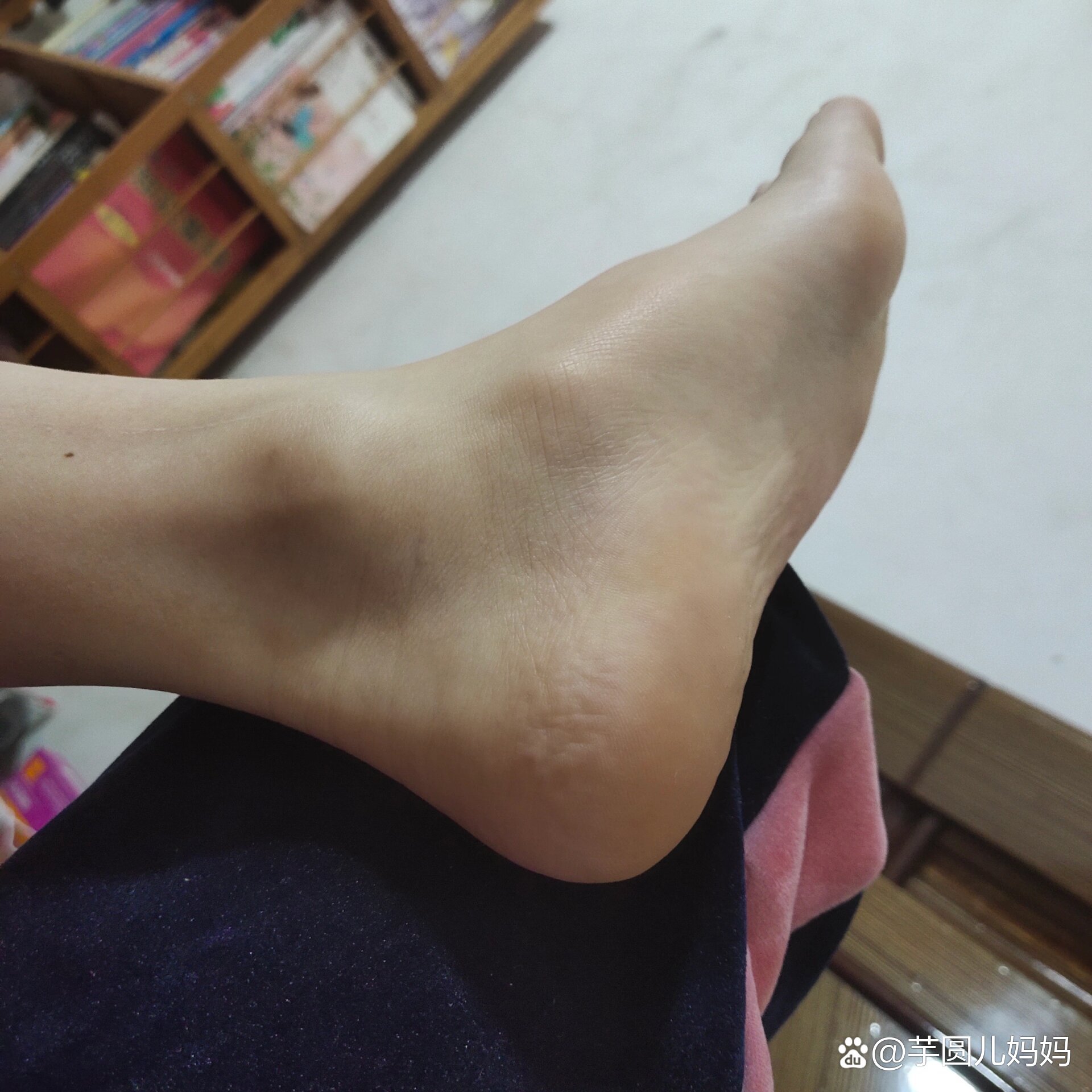 脚上骨有一块骨头突出,走路特别痛