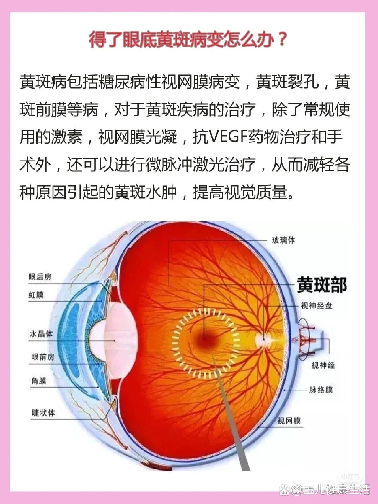 眼睛有黄斑怎么治疗图片