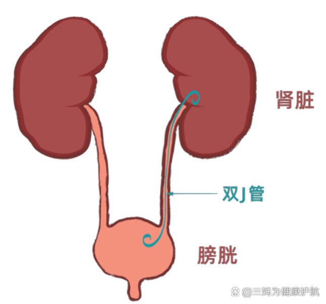 双j管图解图片