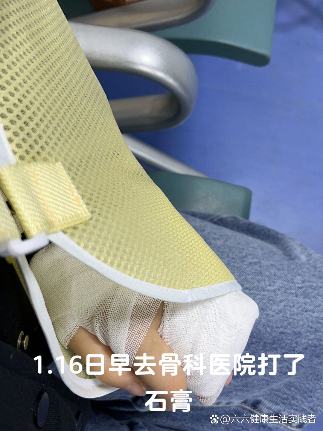 小拇指近节指骨基底部骨折