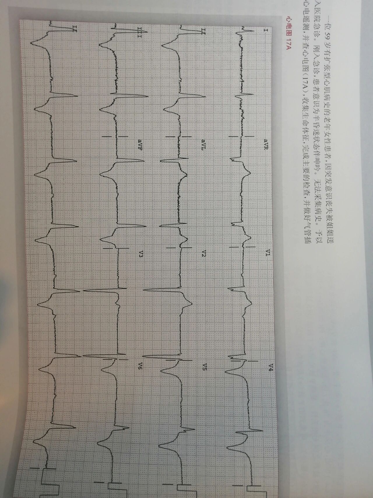 心电图辨认1