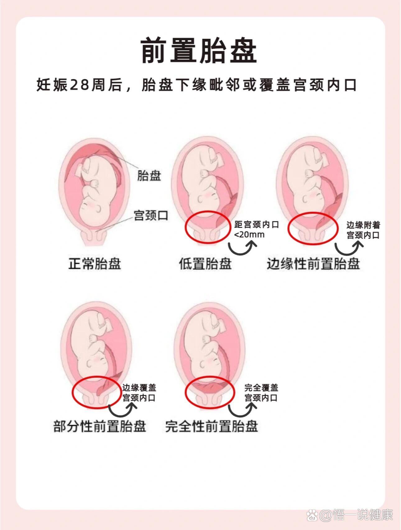 胎盘图片示意图图片