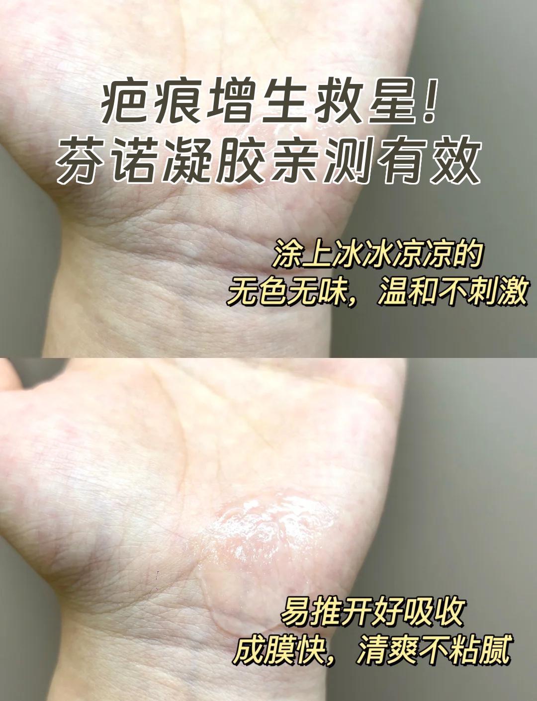 疤痕增生救星！