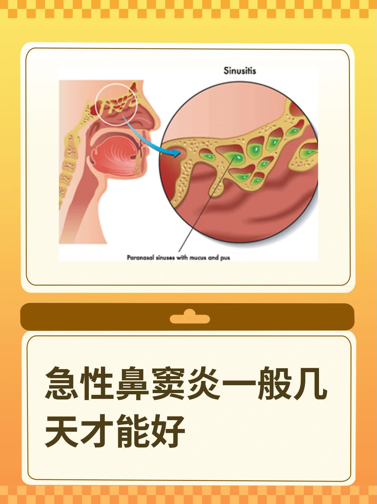 鼻窦炎的治疗的方法图片