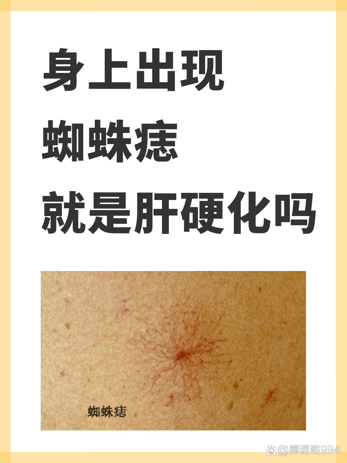身上出现蜘蛛痣,就是肝硬化吗?