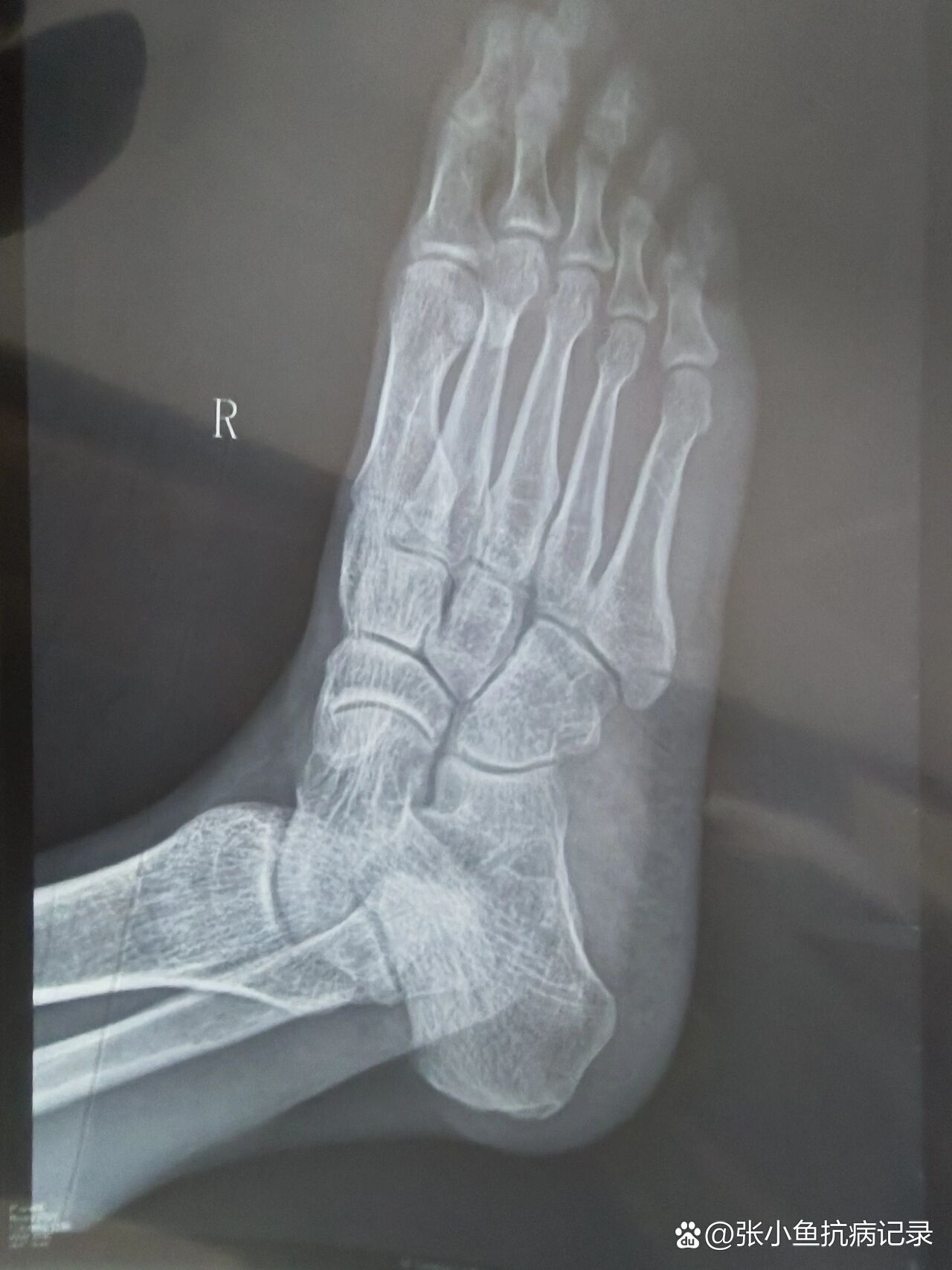 正确叫法是"右足第5跖骨粗隆骨折"
