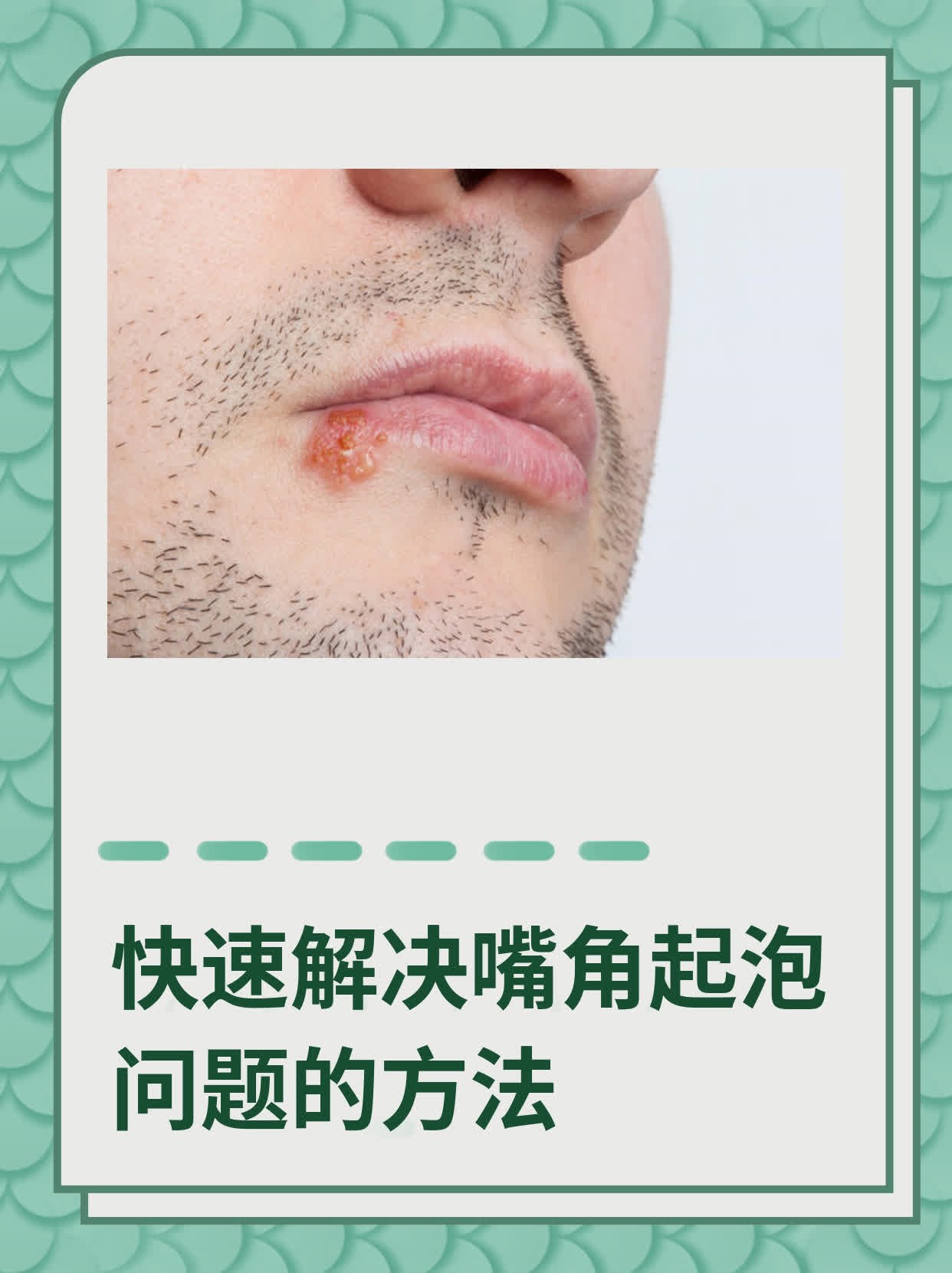 快速解决嘴角起泡问题的方法
