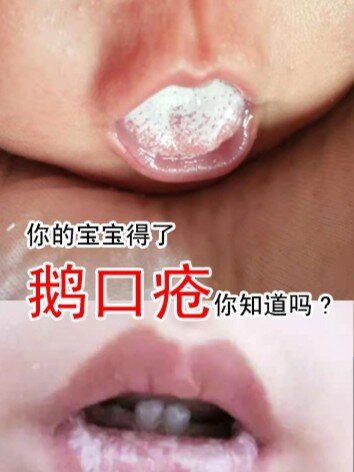 宝宝得了鹅口疮你知道吗?